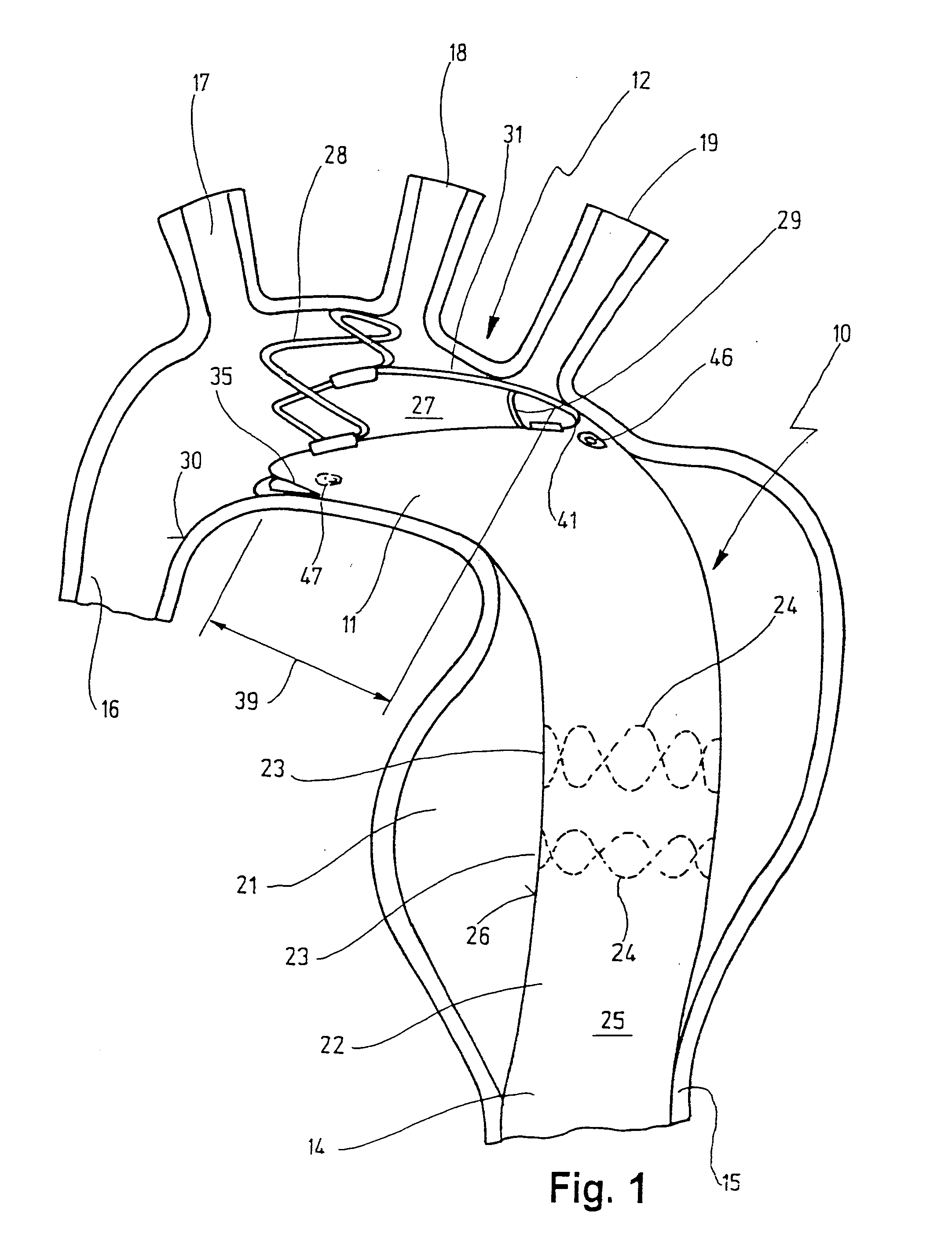 Stent for implantation in a blood vessel, especially in the region of the aortic arch