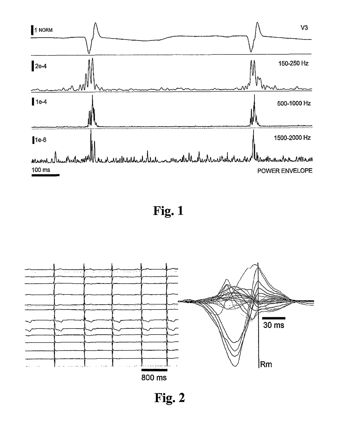 Method of EKG signal processing and apparatus for performing the method