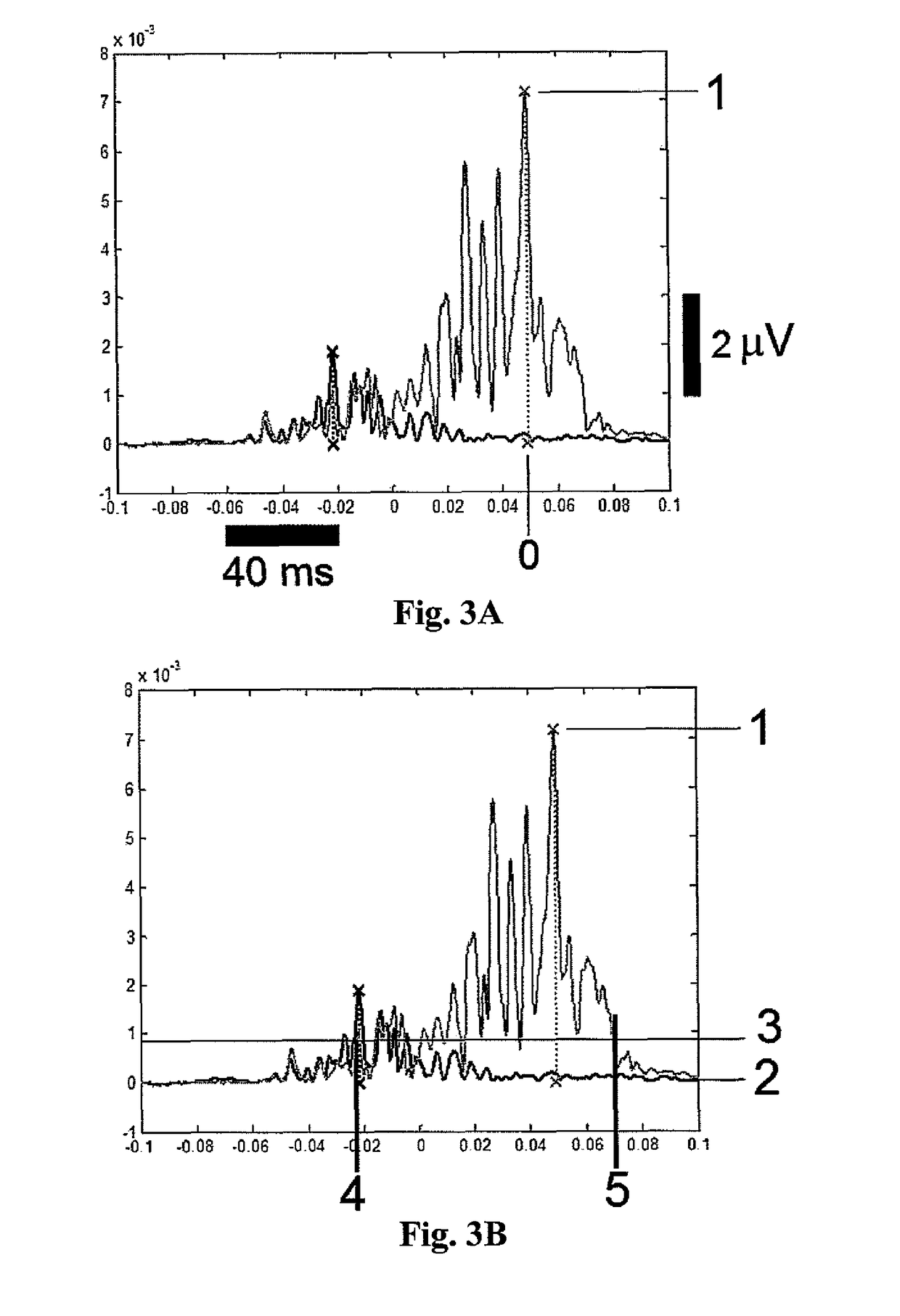 Method of EKG signal processing and apparatus for performing the method