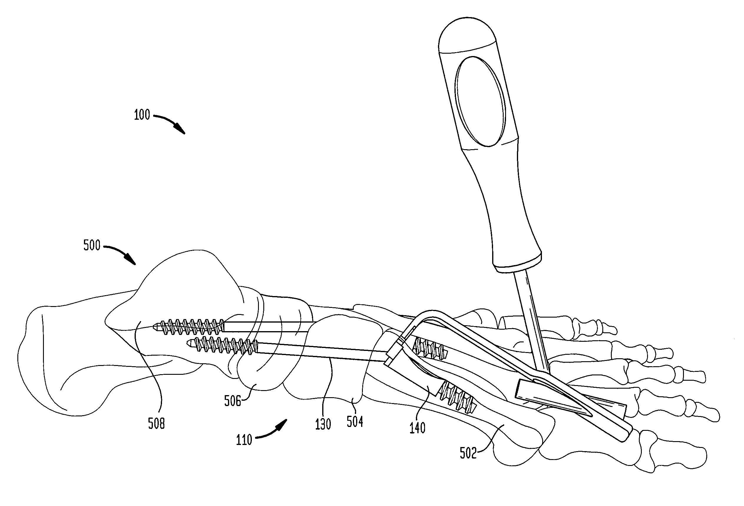 Intramedullary fixation screw, a fixation system, and method of fixation of the subtalar joint