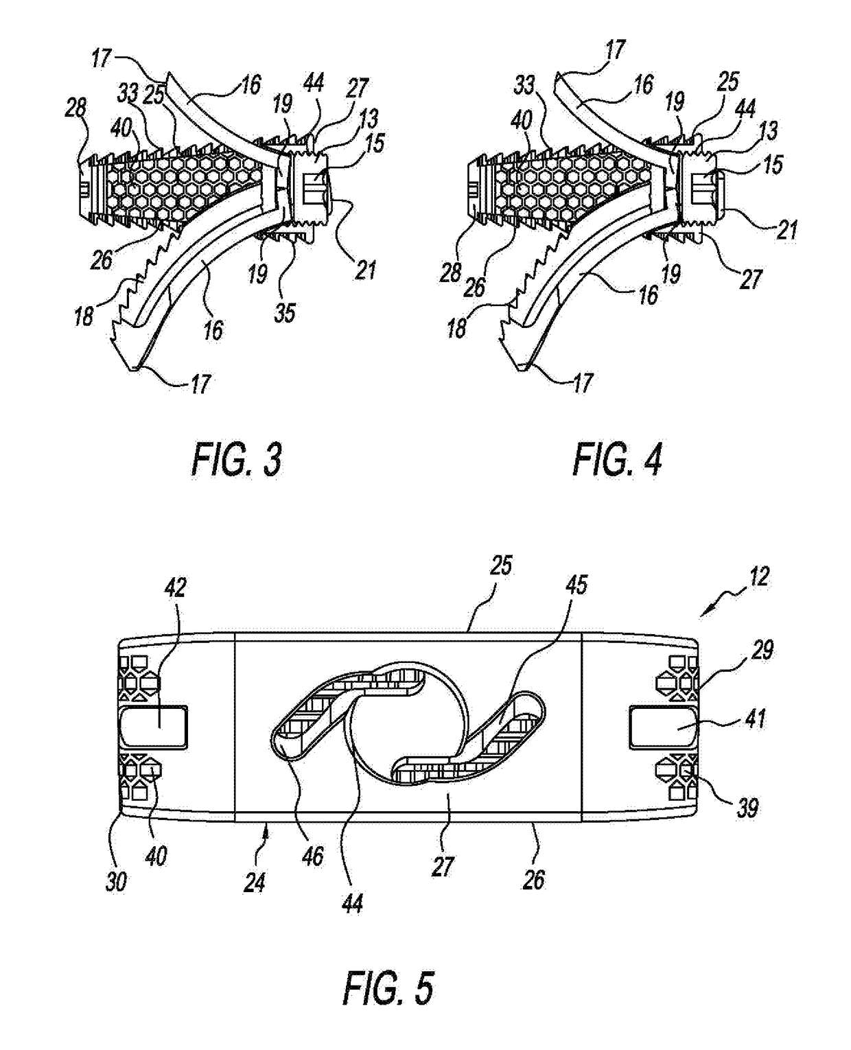 Stand-Alone ALIF Spine Implants