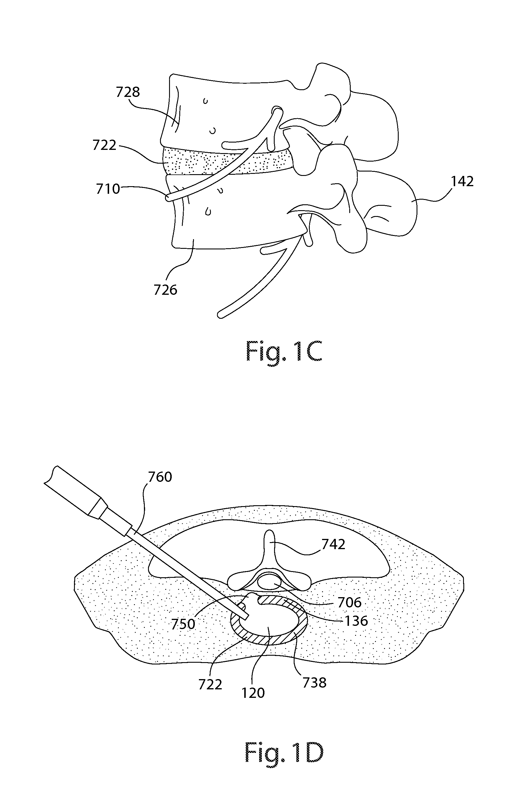 Devices and methods for spine repair