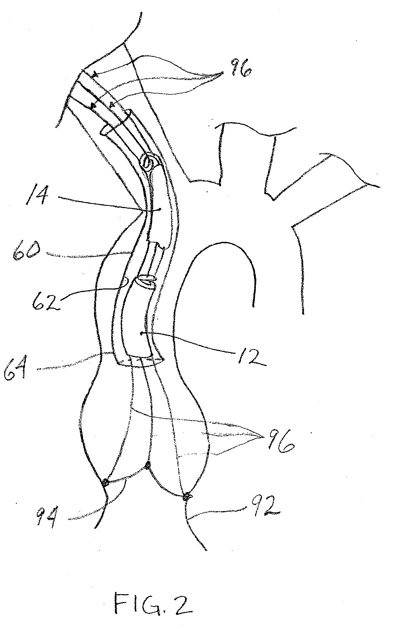 Two-piece percutaneous prosthetic heart valves and methods for making and using them