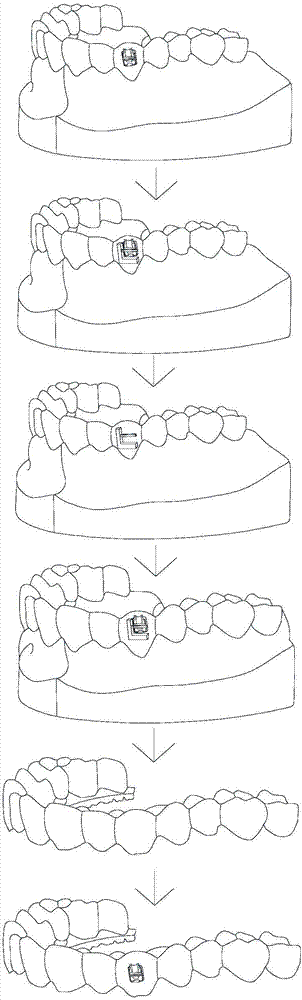Indirect bonding method of goal-directed localization orthodontic bracket