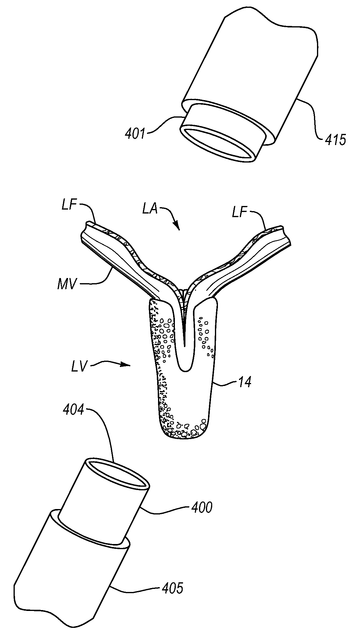Mitral valve fixation device removal devices and methods