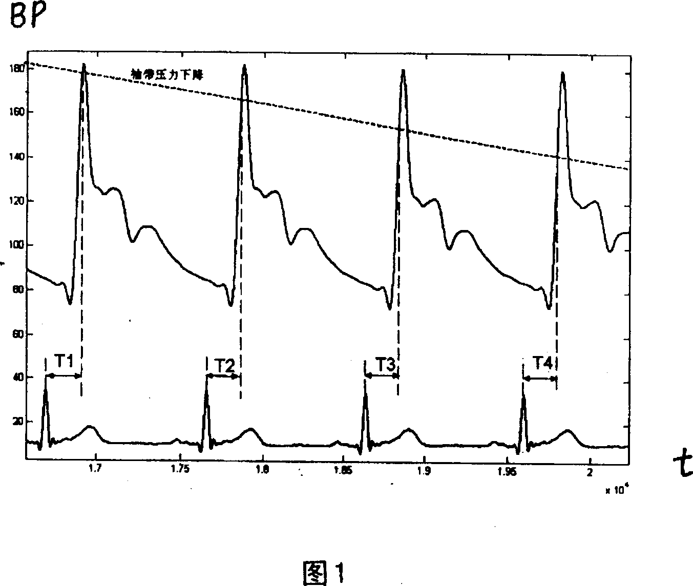 Detection method with blood pressure monitor and korotkoff sound delaying and pulse wave conducting time signal generator