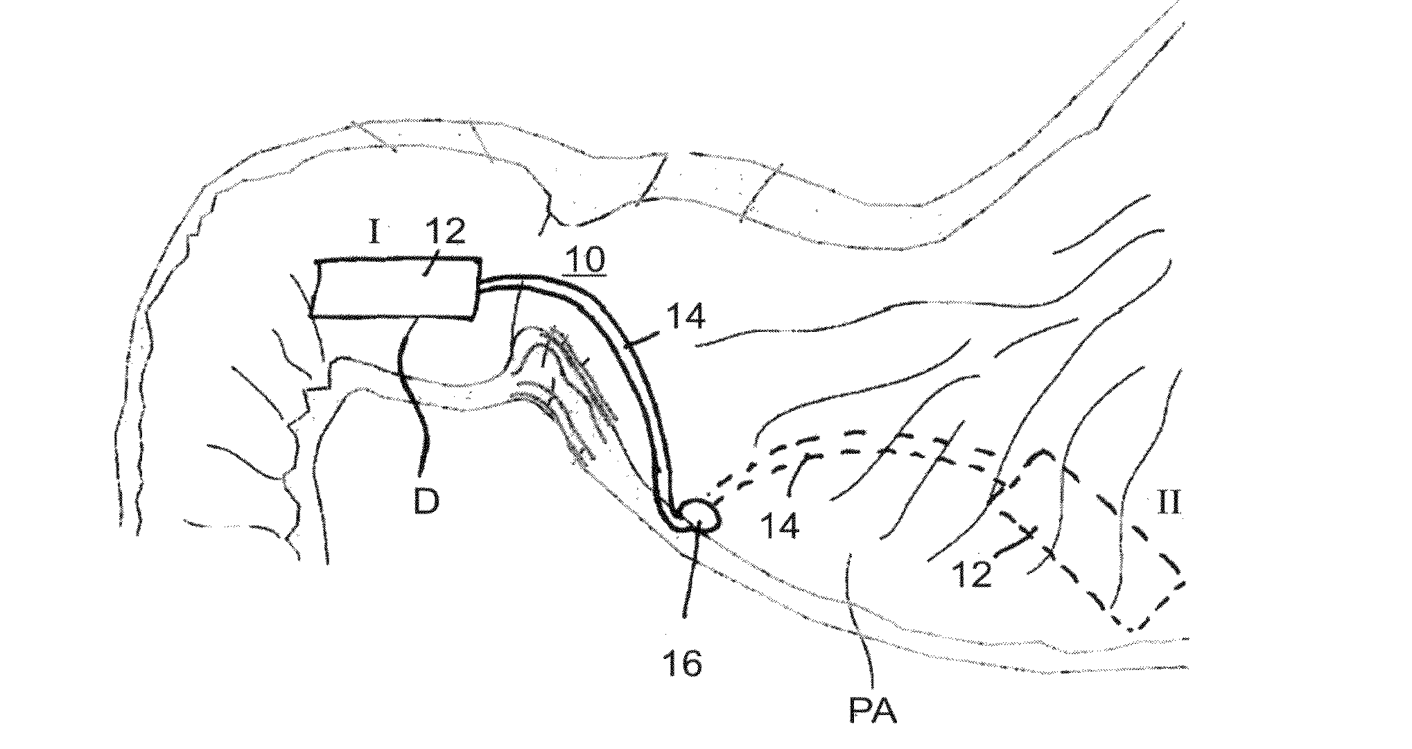 Devices and methods for altering eating behavior