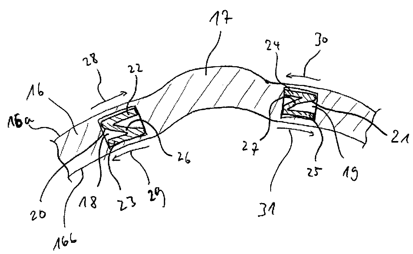 Means and Device for Compensating a Local Deformation of the Cornea of an Eye