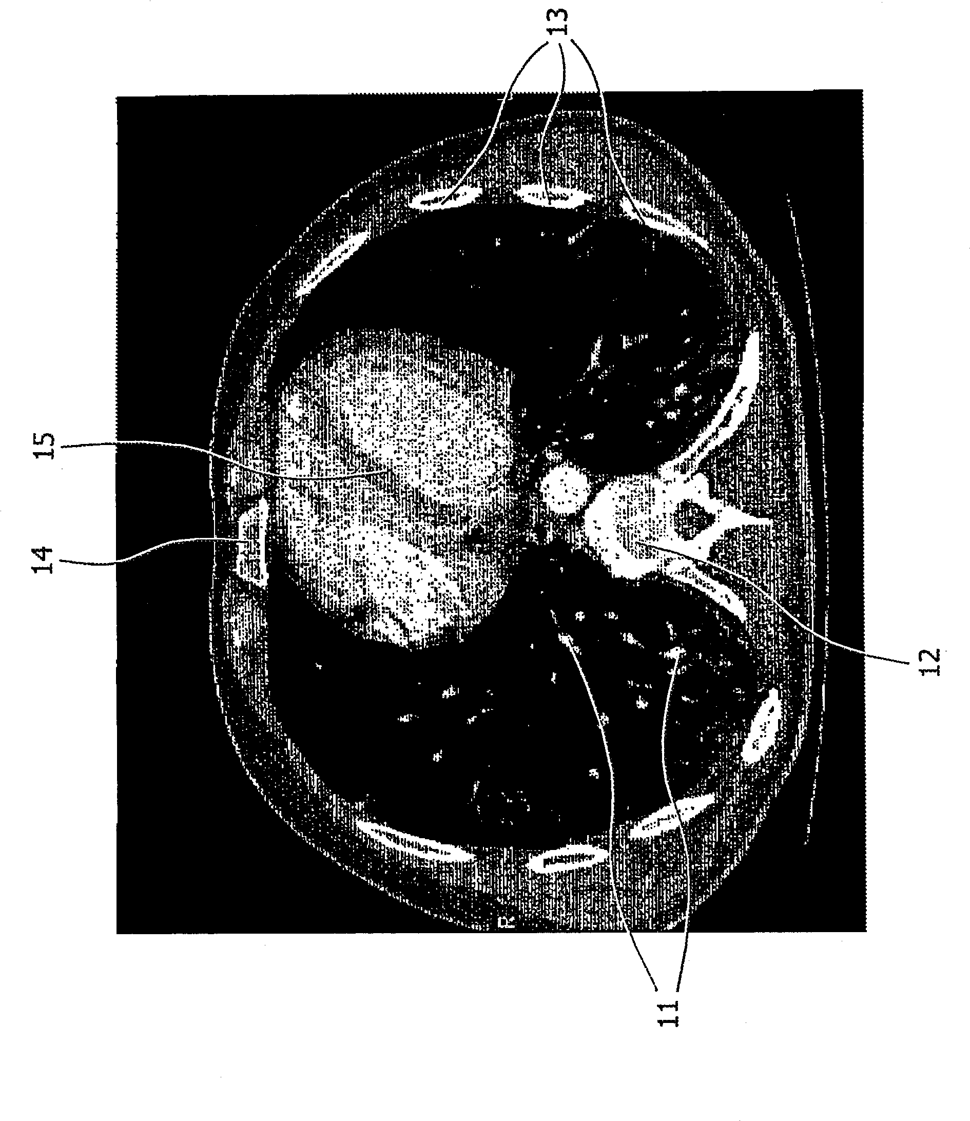 A method, apparatus, graphical user interface, computer-readable medium, and use for quantification of a structure in an object of an image dataset