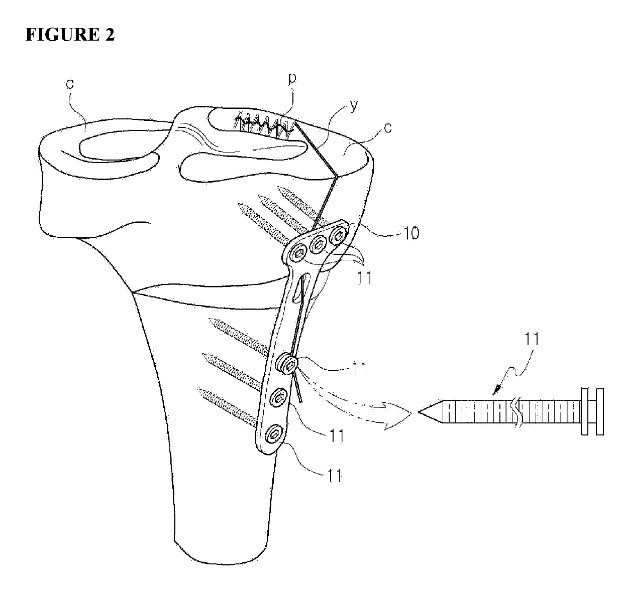 Fixing tool for open-wedge high tibial osteotomy