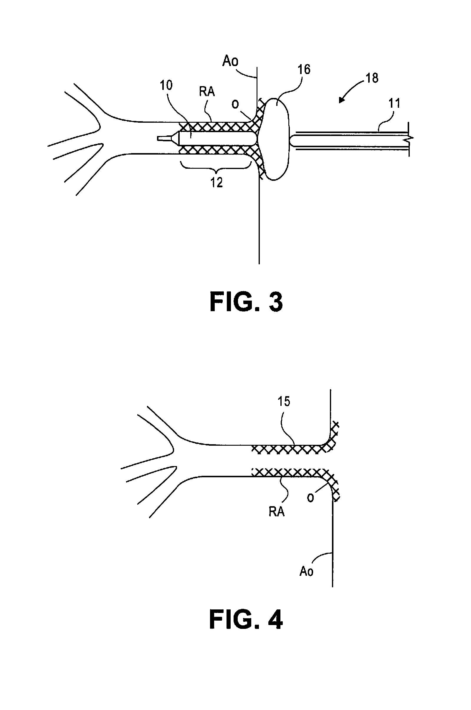 Stent and stent delivery system for side-branch locations in a conduit