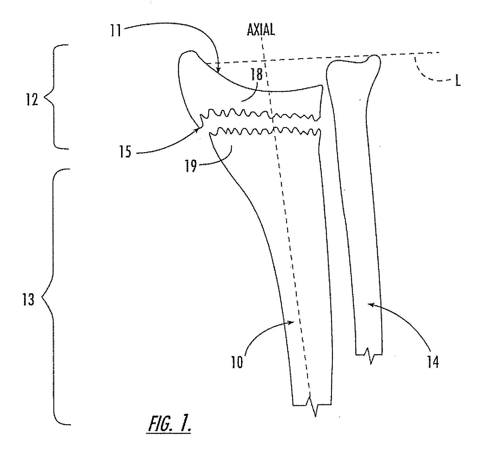 Intramedullary interlocking fixation devices for the distal radius