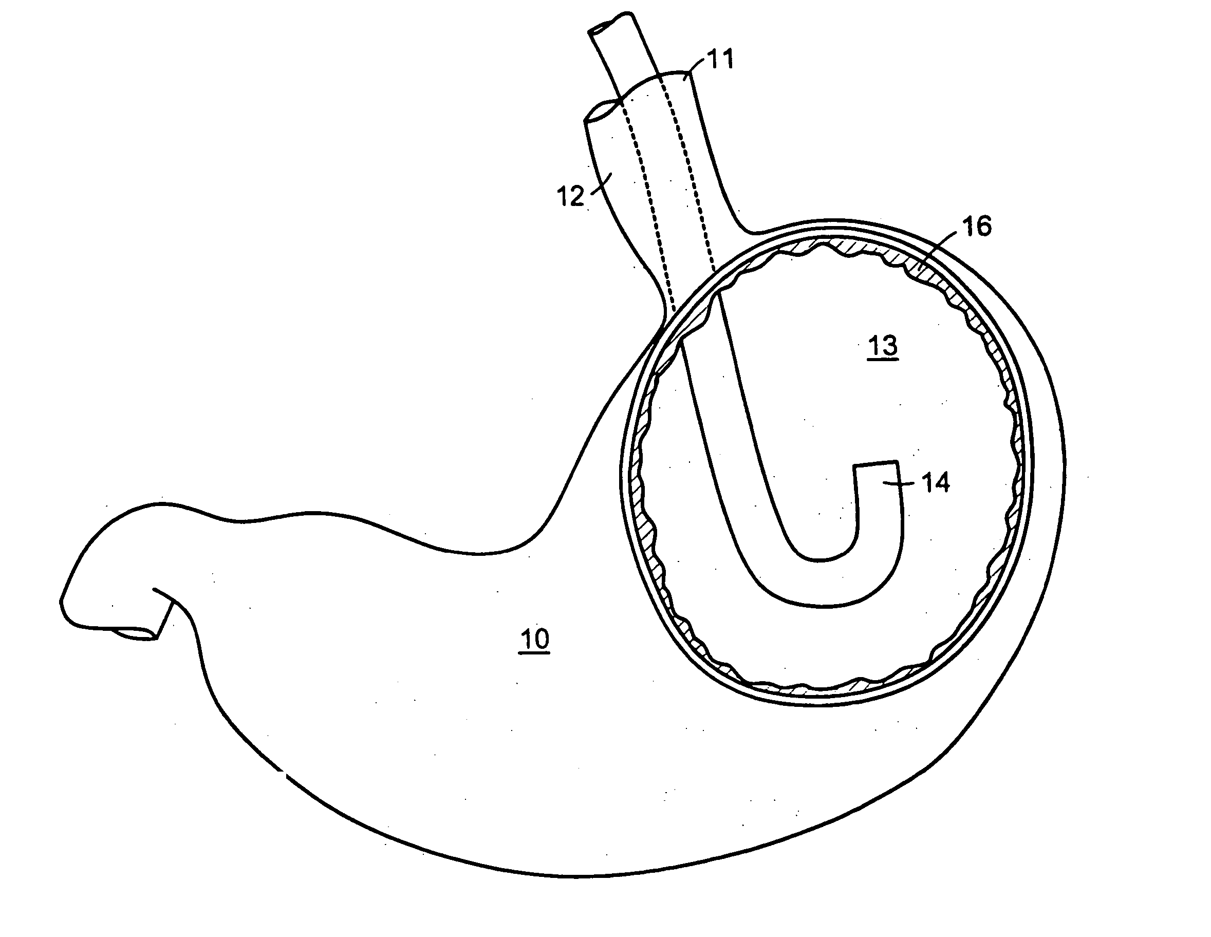Methods and devices for tissue reconfiguration