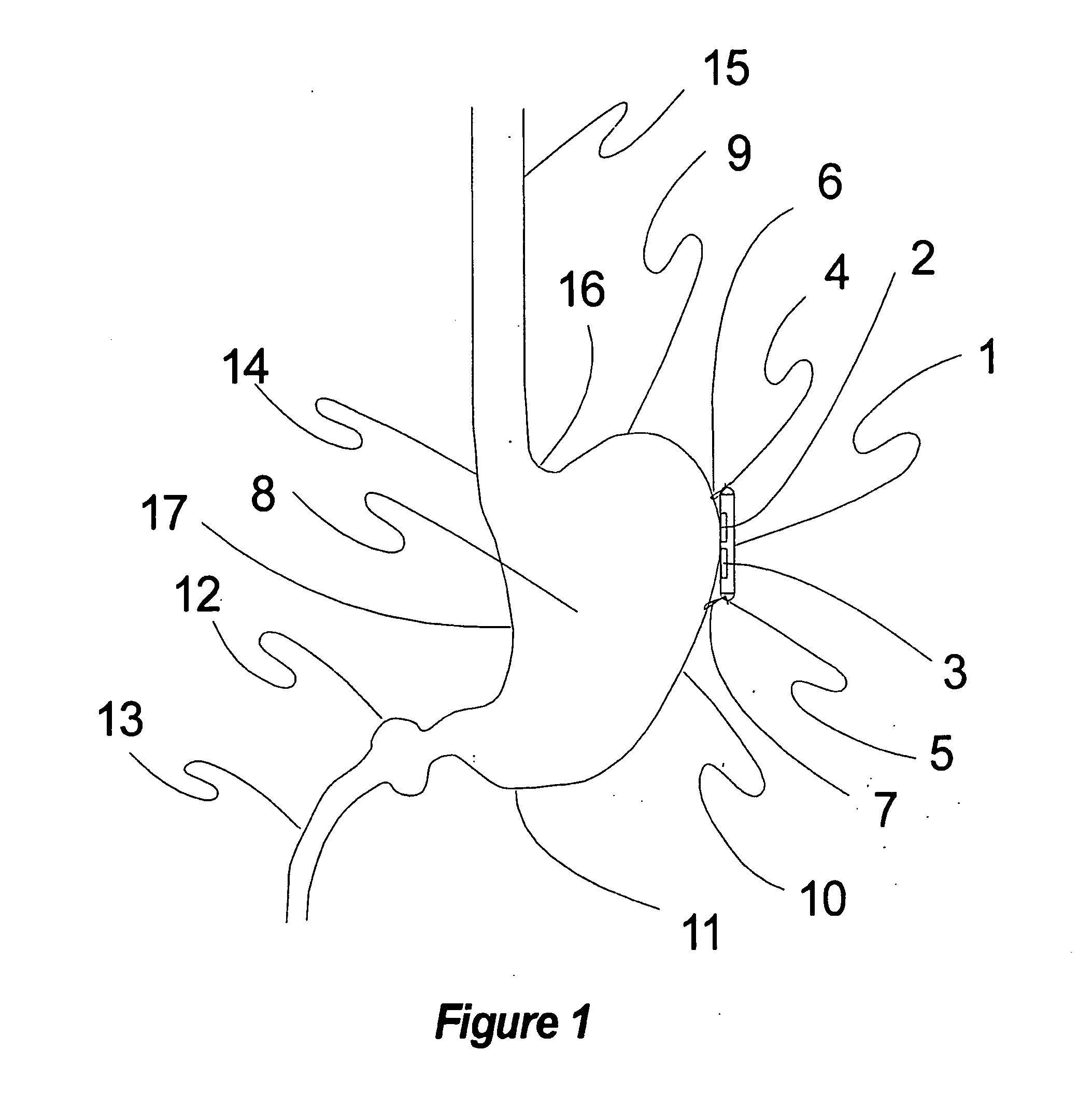 Method, apparatus, surgical technique, and stimulation parameters for autonomic neuromodulation for the treatment of obesity