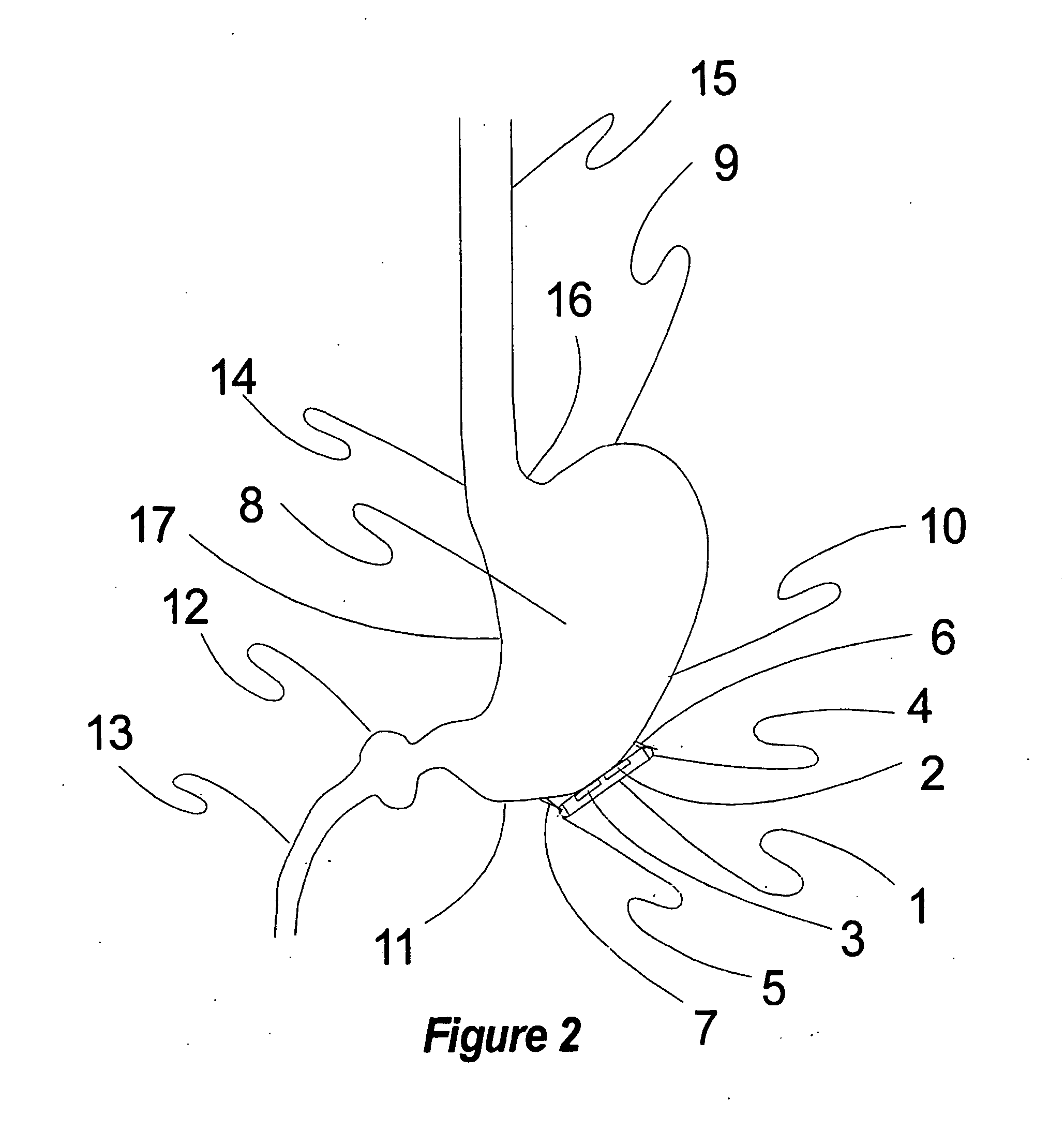 Method, apparatus, surgical technique, and stimulation parameters for autonomic neuromodulation for the treatment of obesity