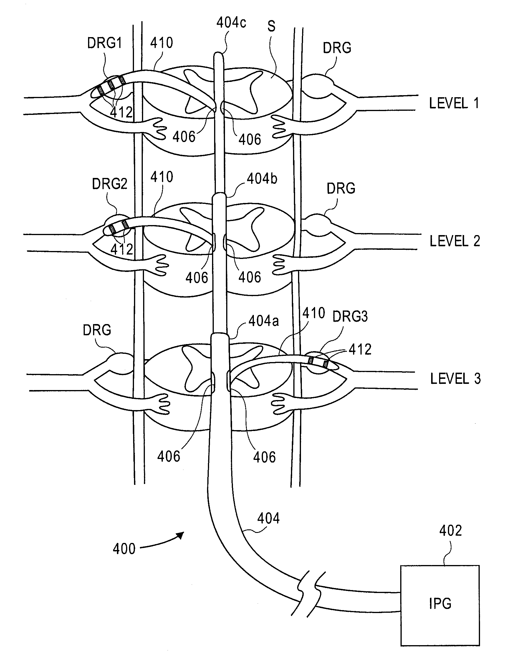 Delivery devices, systems and methods for stimulating nerve tissue on multiple spinal levels