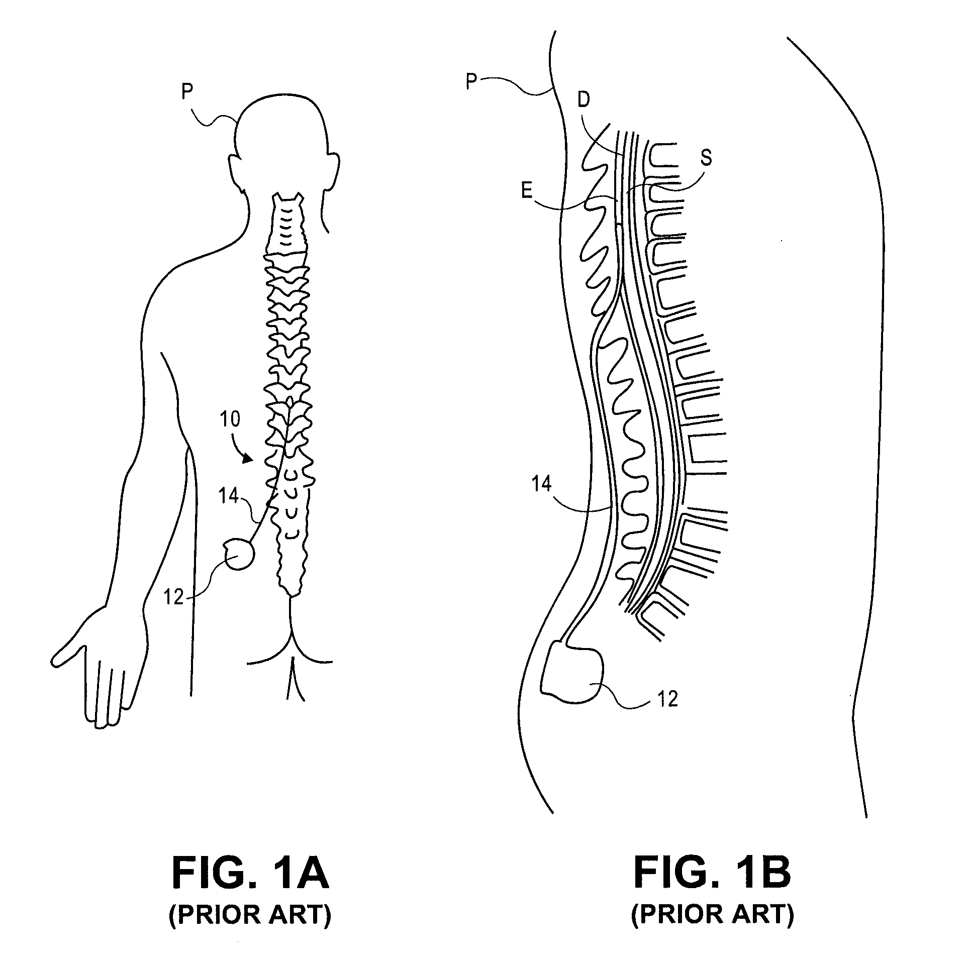 Delivery devices, systems and methods for stimulating nerve tissue on multiple spinal levels