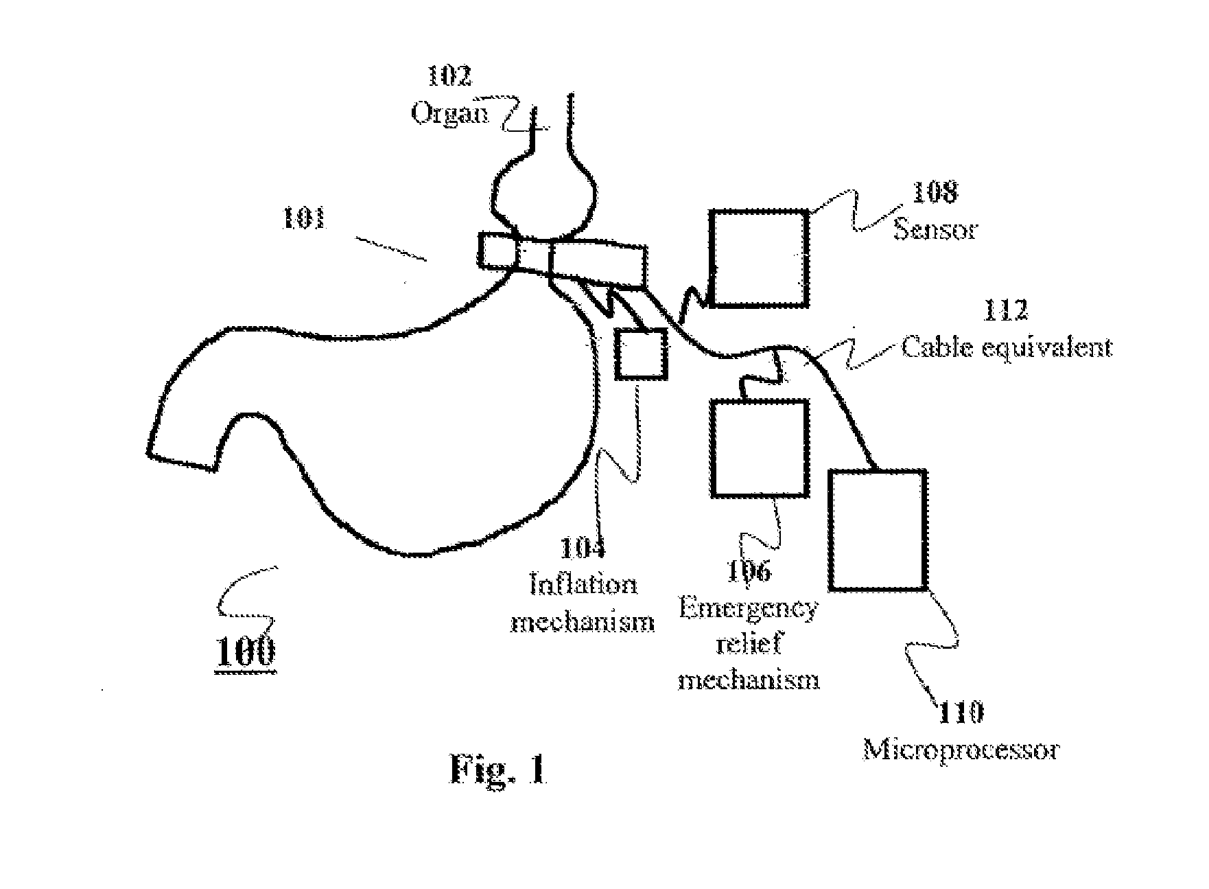 Apparatus and methods for corrective guidance of eating behavior after weight loss surgery