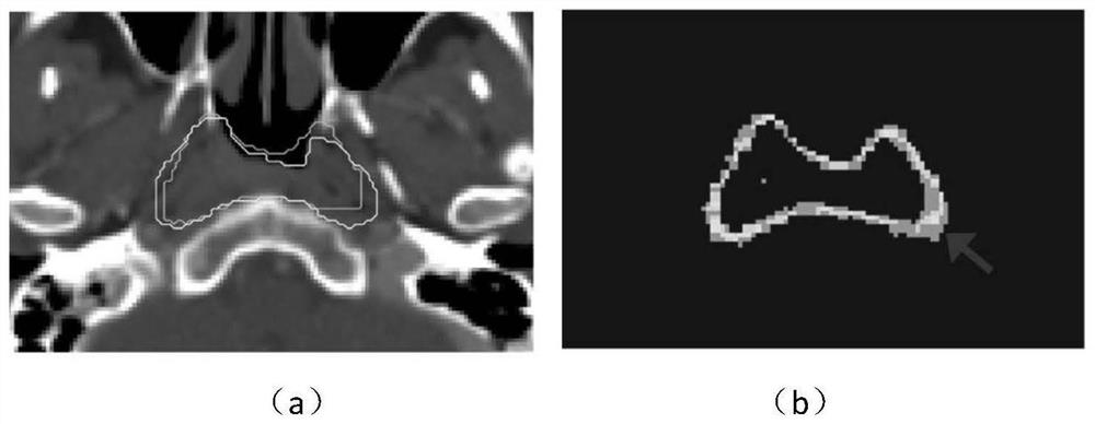 CT image-based nasopharyngeal carcinoma radiotherapy target region automatic sketching method