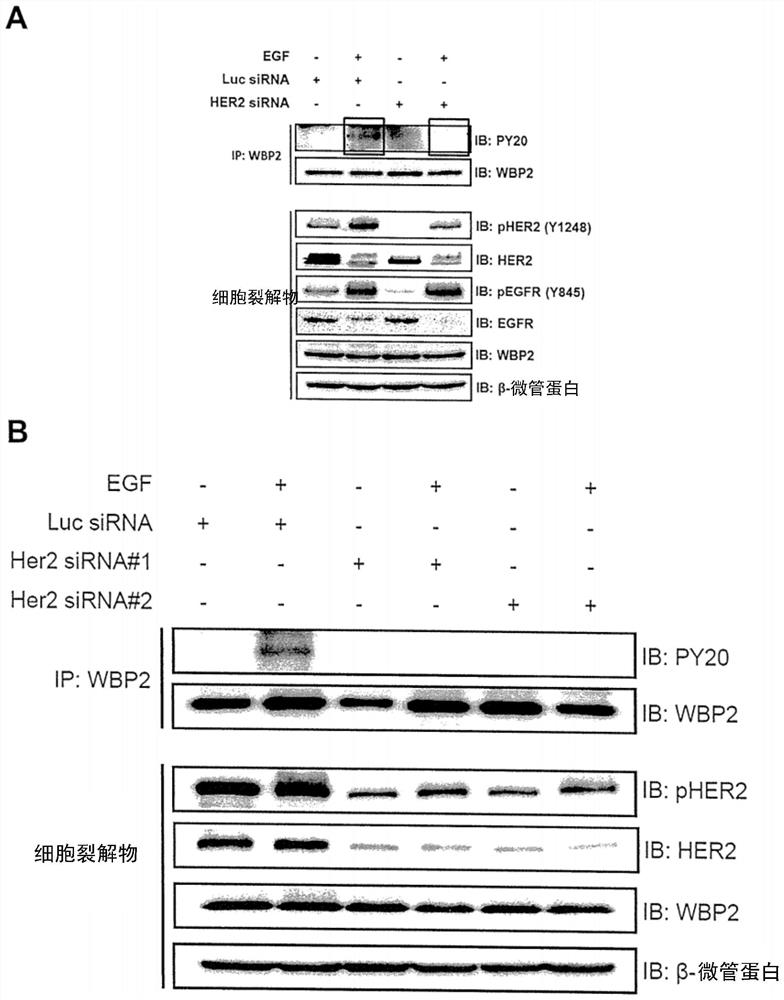 WBP2 and HER2 act as co-prognostic factors to stratify patients for treatment