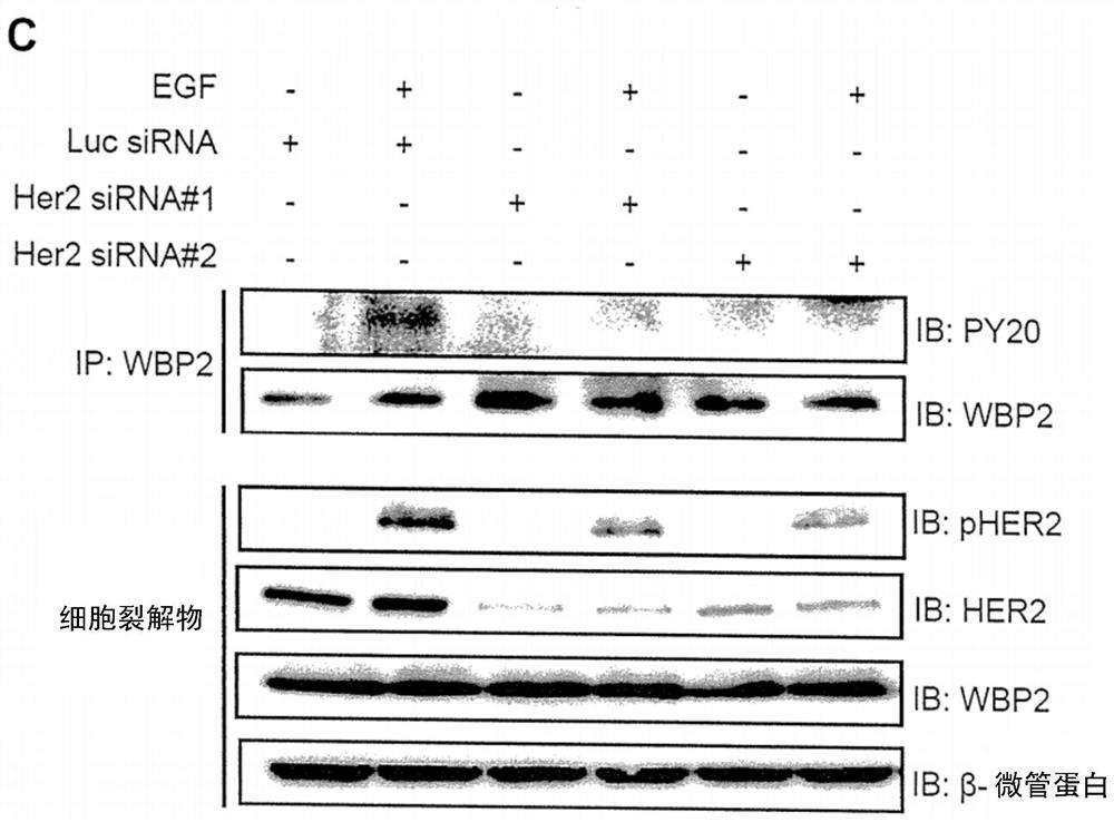 WBP2 and HER2 act as co-prognostic factors to stratify patients for treatment