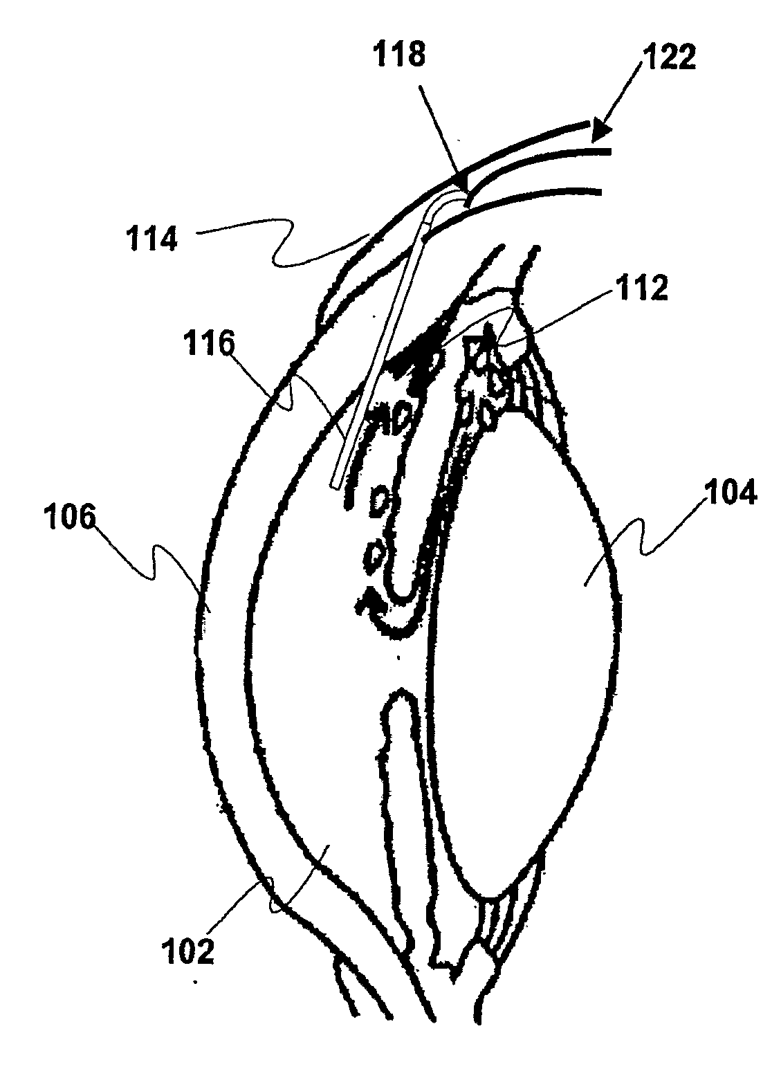 Systems and Methods for Monitoring and Controlling Internal Pressure of an Eye or Body Part