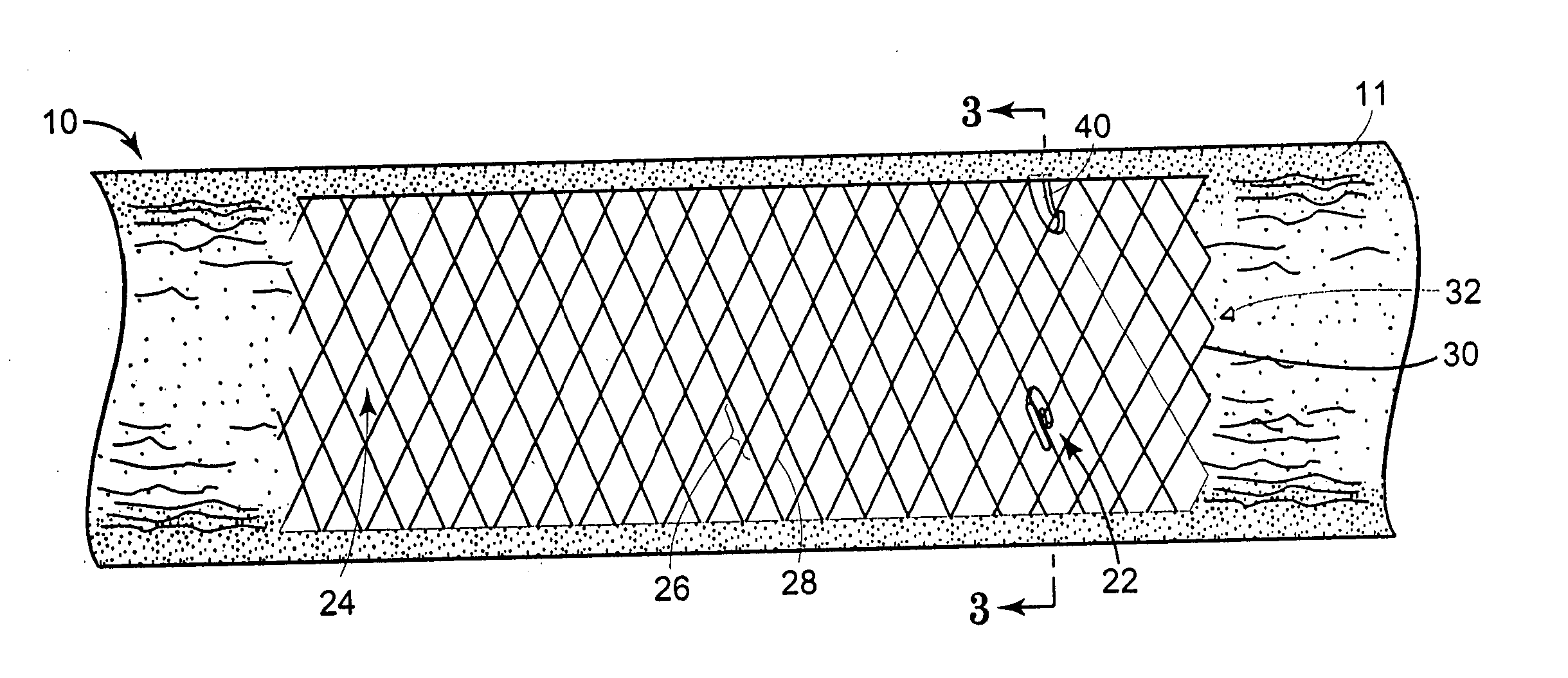 Retrievable stent and method of use thereof