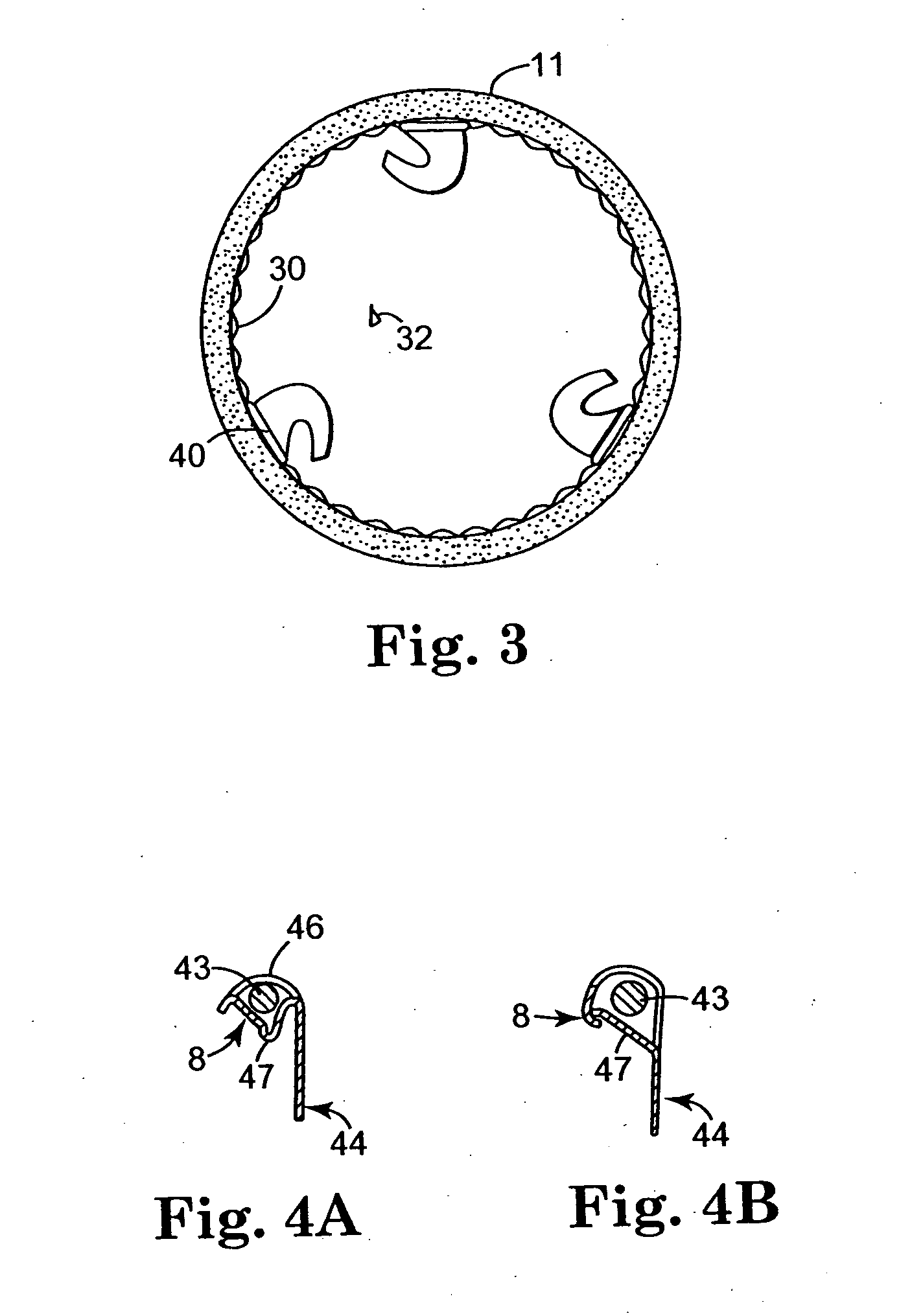 Retrievable stent and method of use thereof