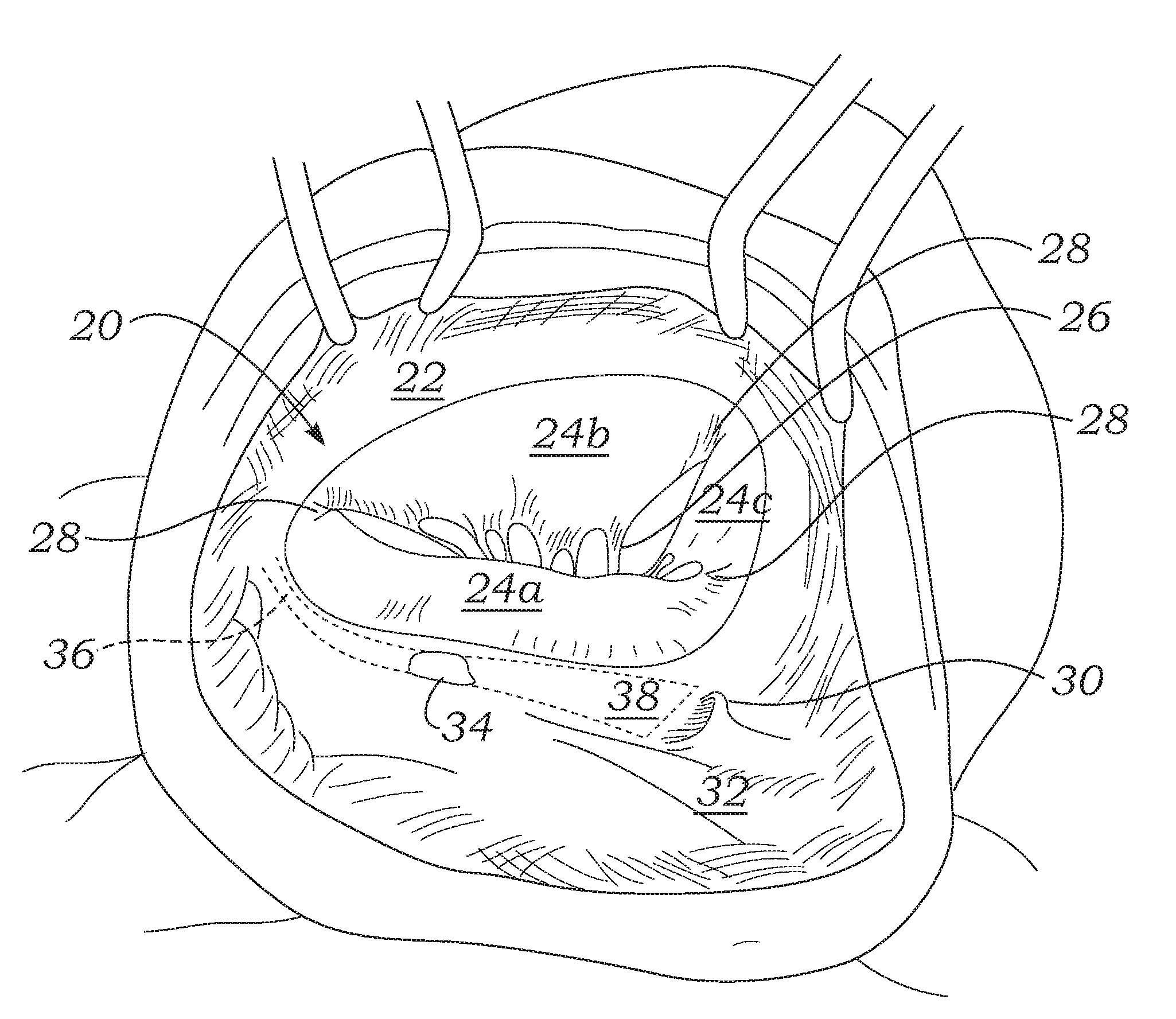 Physiologic tricuspid annuloplasty ring
