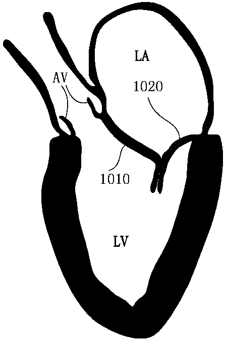 Cardiac valve repair system