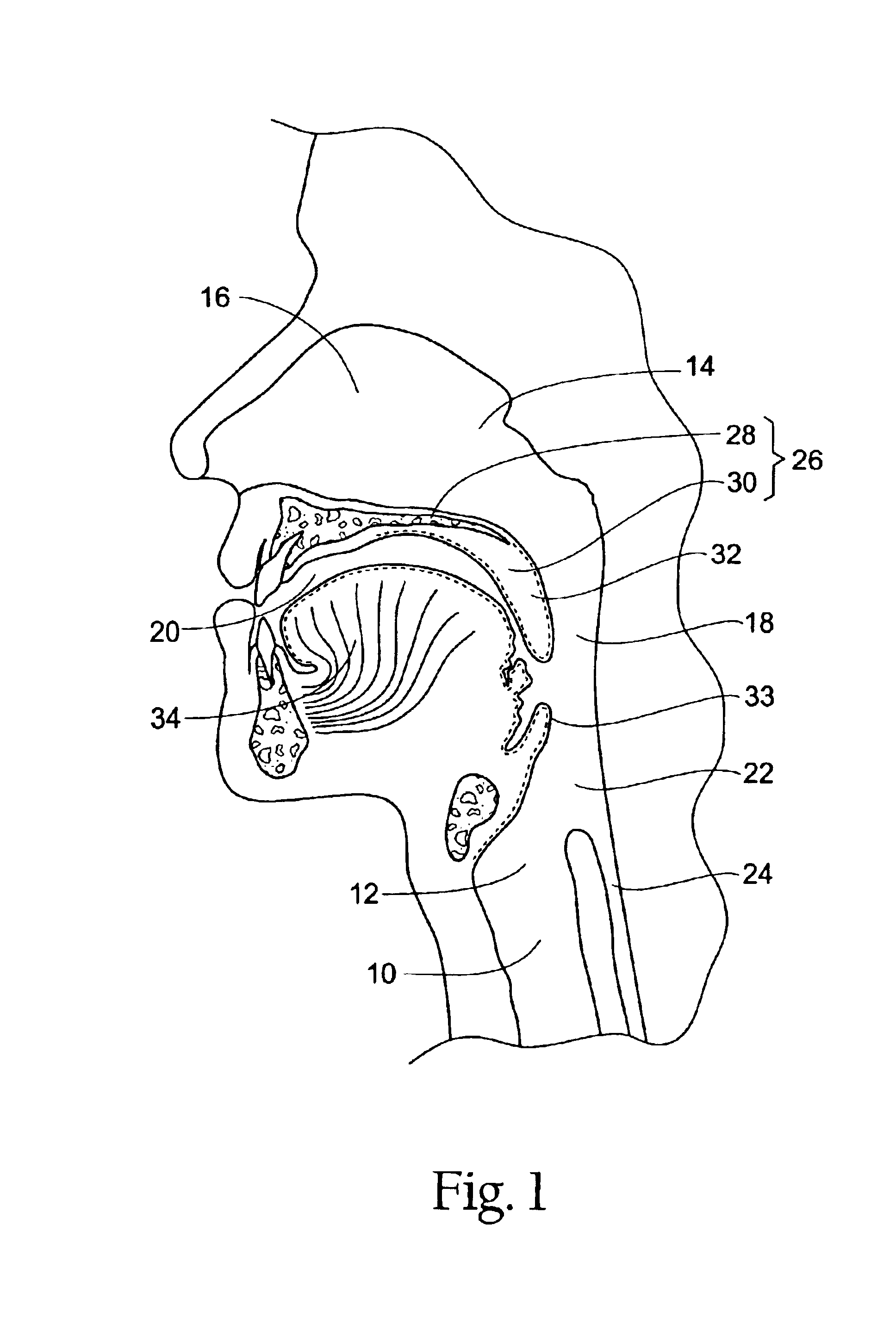 Systems and methods for moving and/or restraining the tongue in the oral cavity