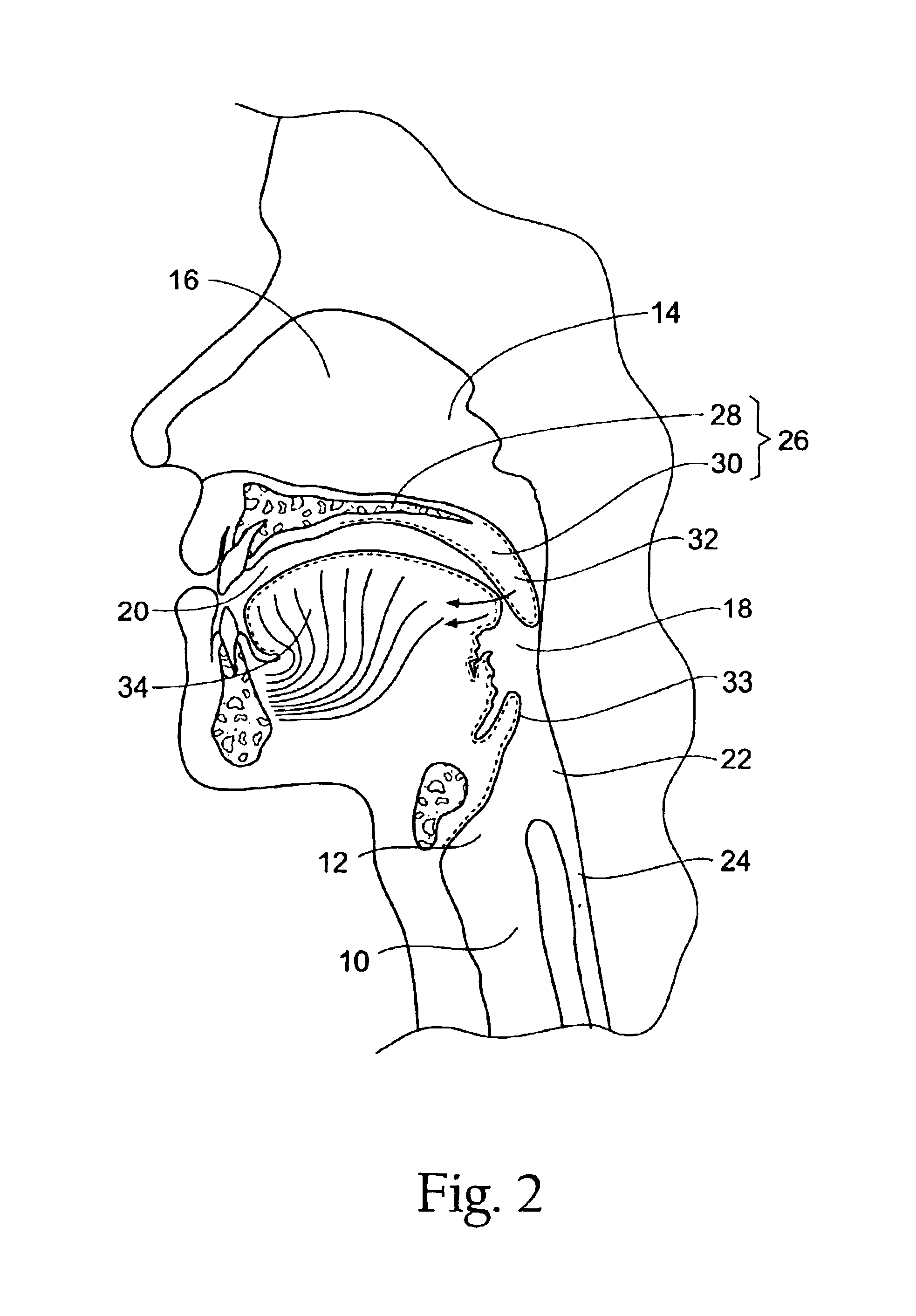 Systems and methods for moving and/or restraining the tongue in the oral cavity