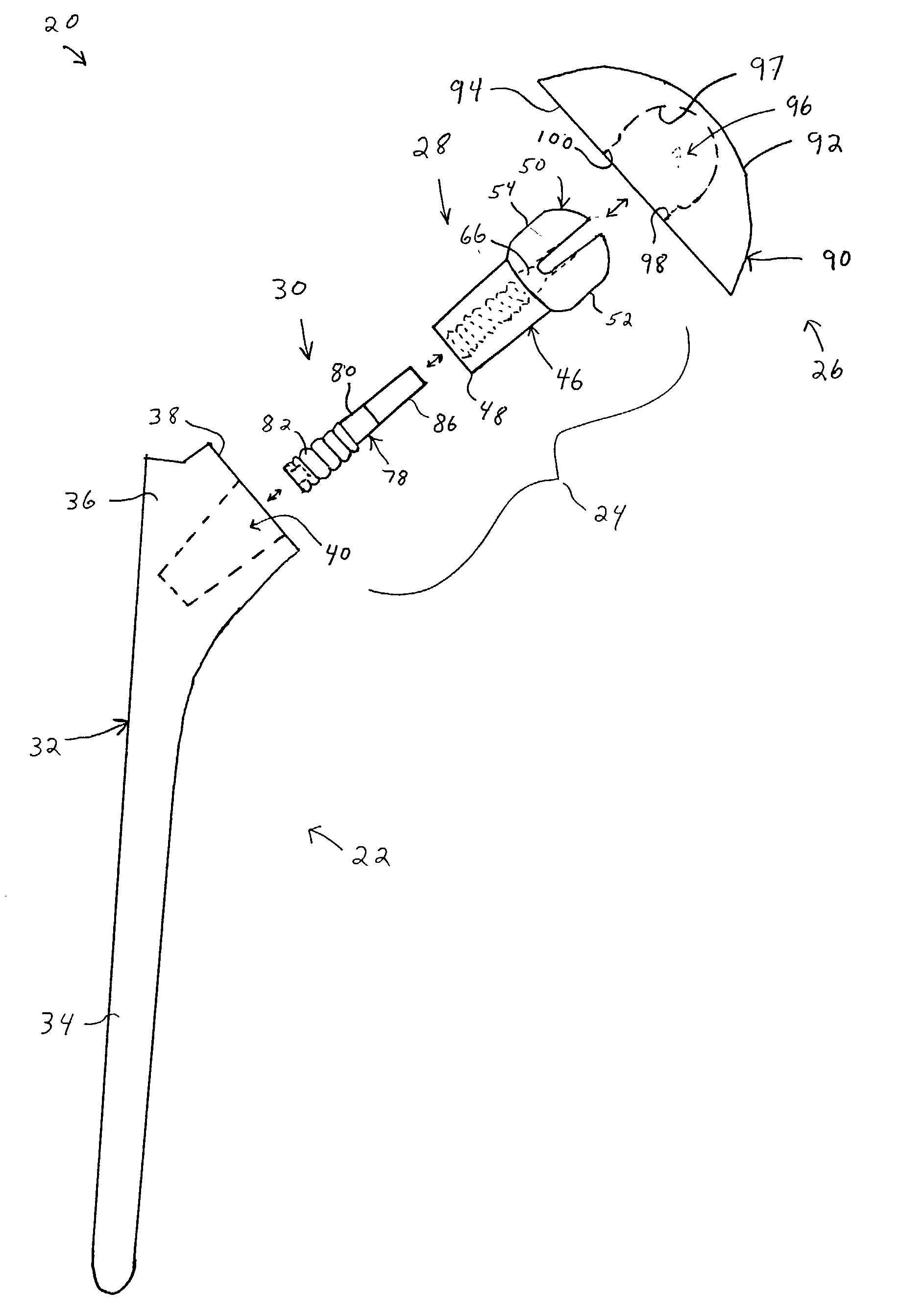 Shoulder prosthesis having a removable conjoining component coupling a humeral component and humeral head and providing infinitely adjustable positioning of an articular surface of the humeral head