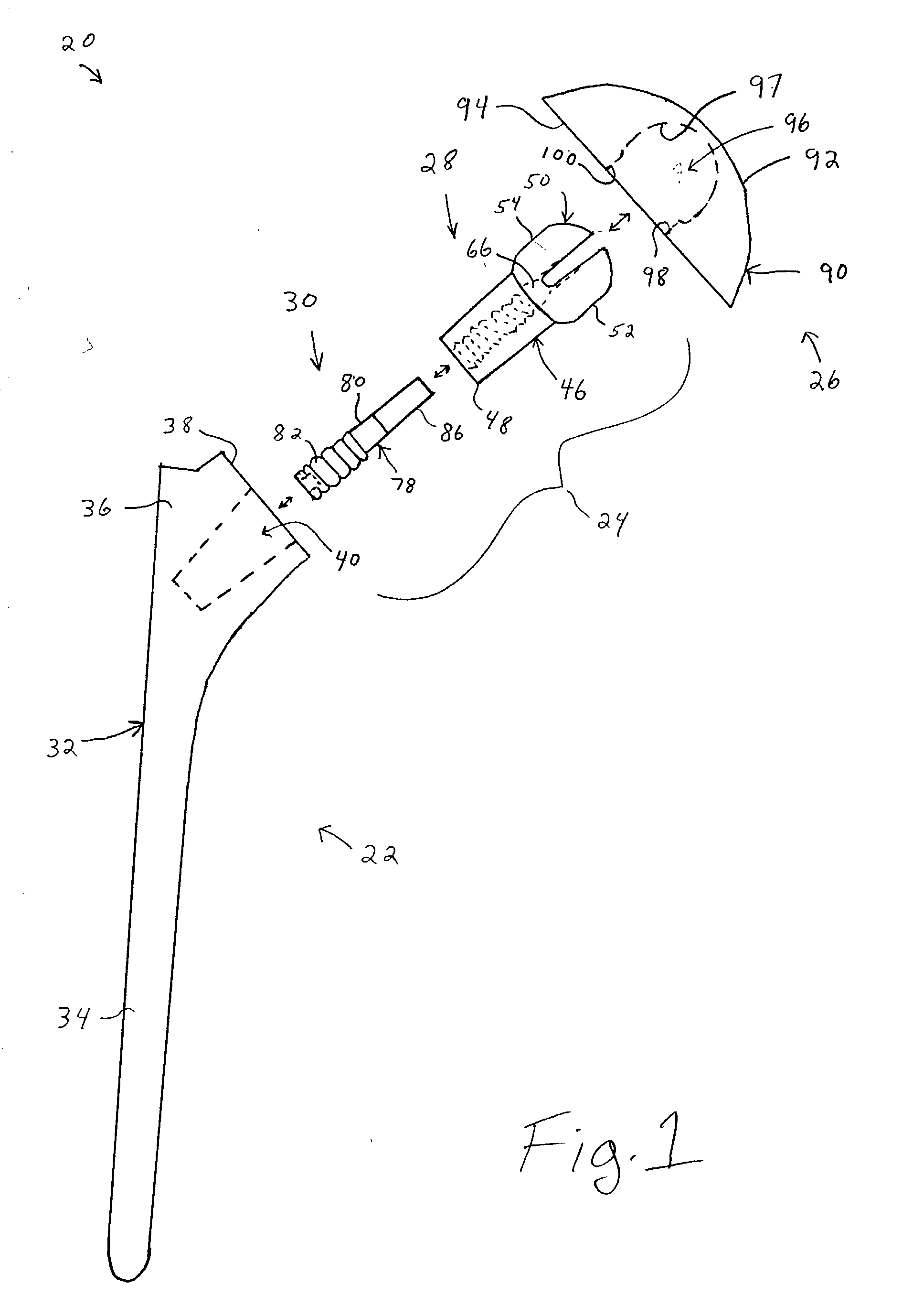 Shoulder prosthesis having a removable conjoining component coupling a humeral component and humeral head and providing infinitely adjustable positioning of an articular surface of the humeral head