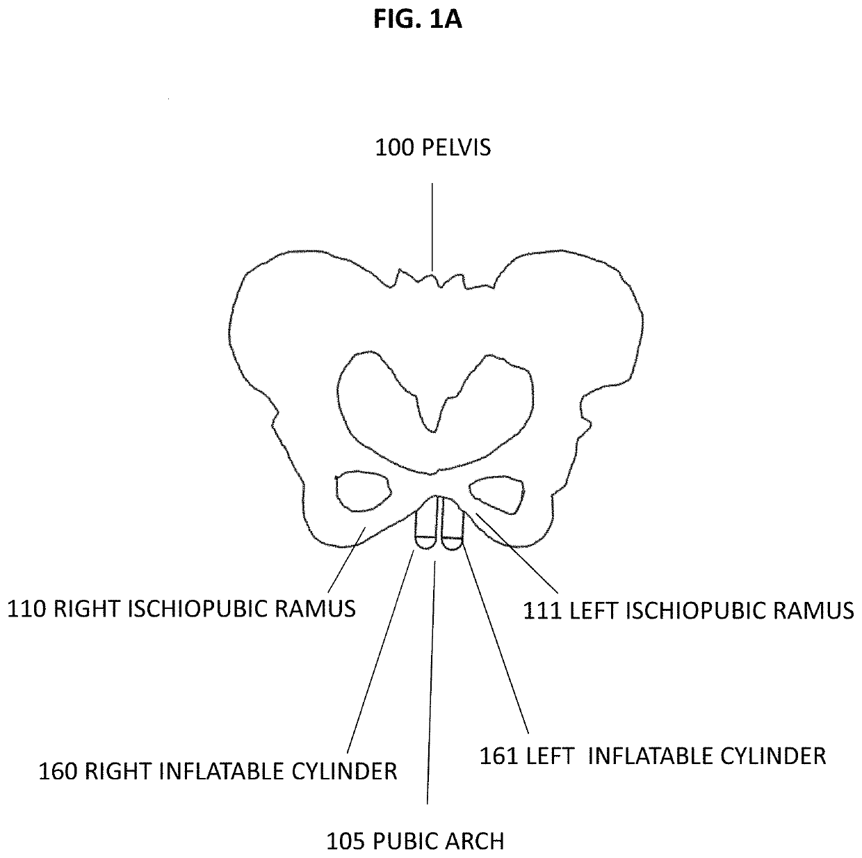 Pelvic anchor for penile prosthetic implants