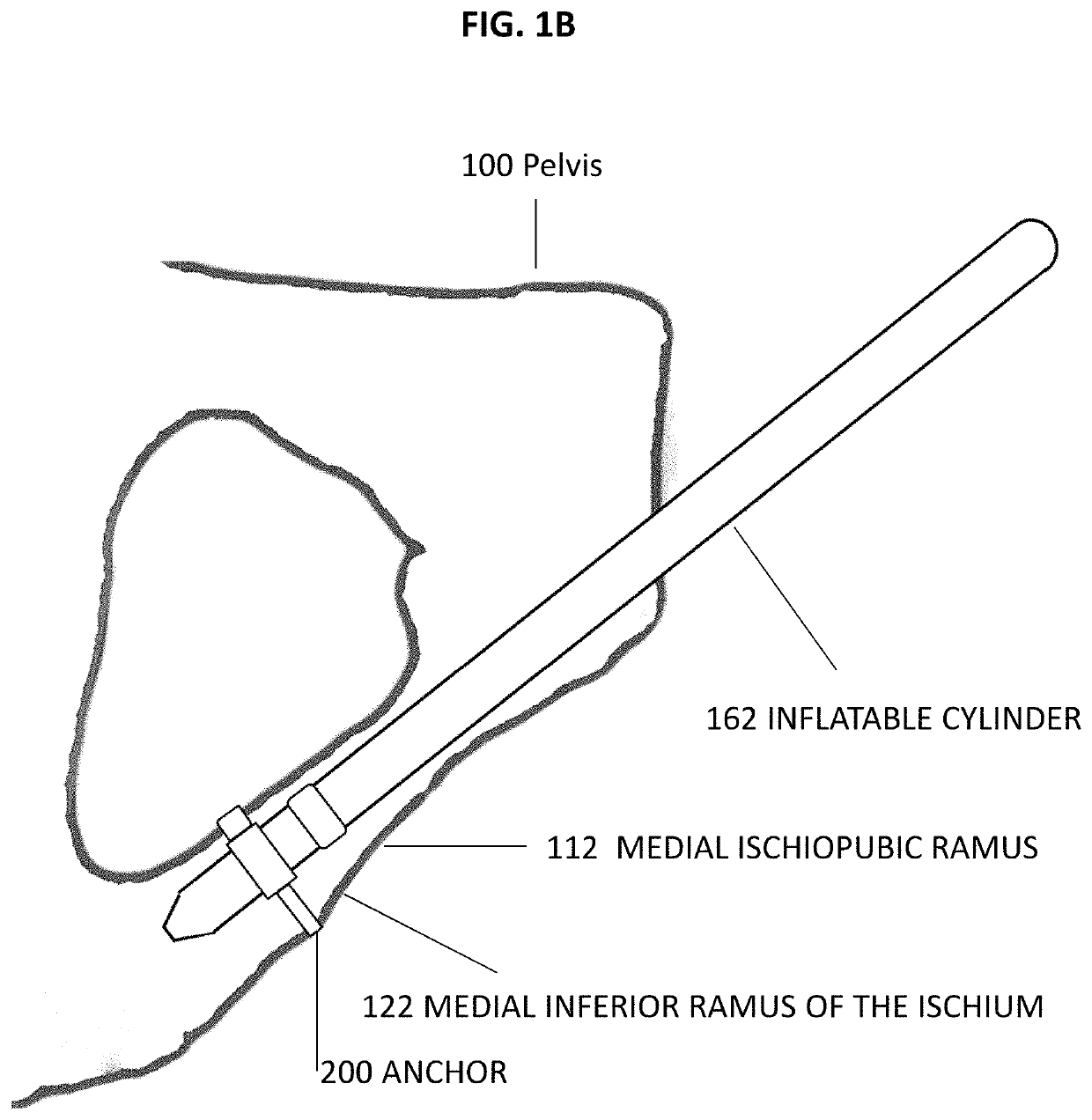 Pelvic anchor for penile prosthetic implants