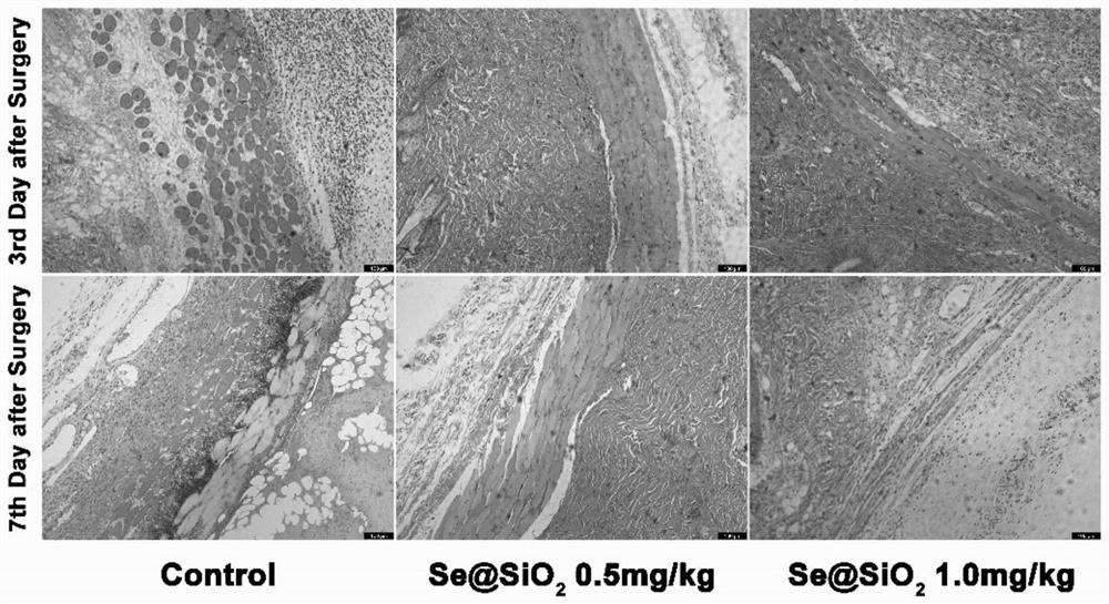 Application of Se@SiO2 nano-selenium core-shell material in flap transplantation