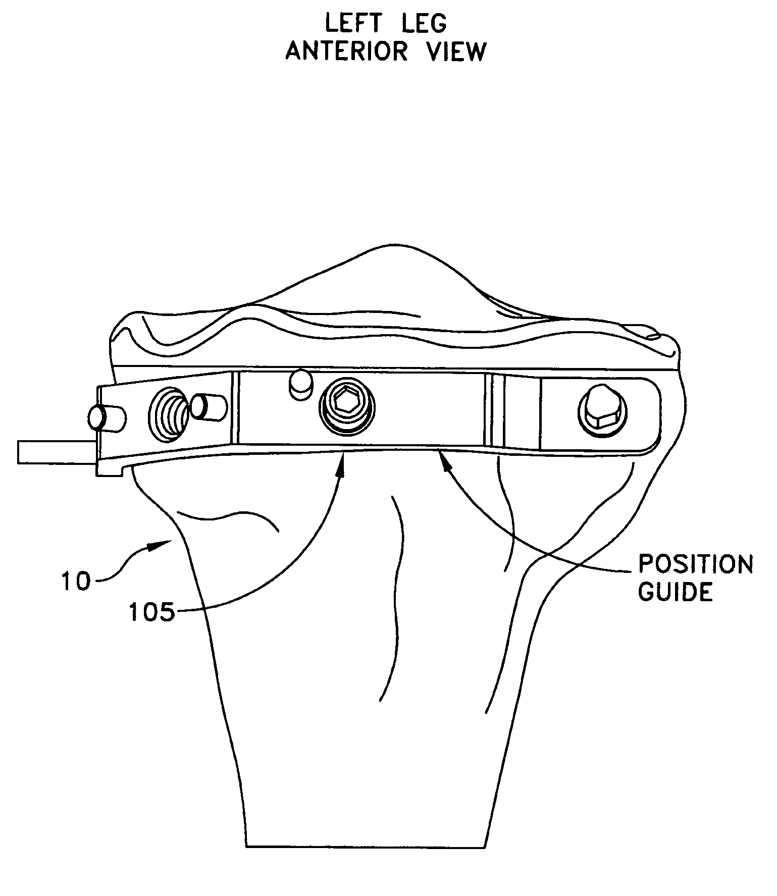 Method and apparatus for forming a wedge-like opening in a bone for an open wedge osteotomy
