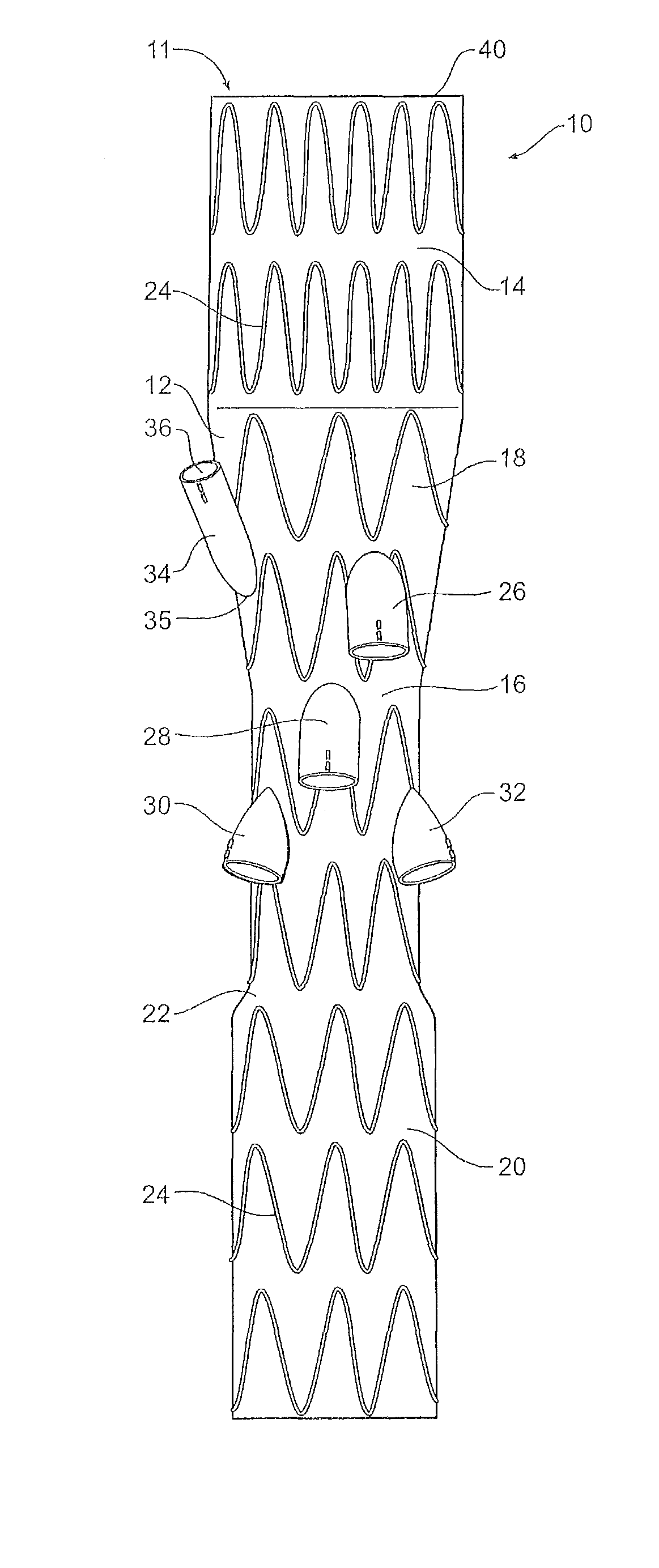 Paraplegia prevention stent graft