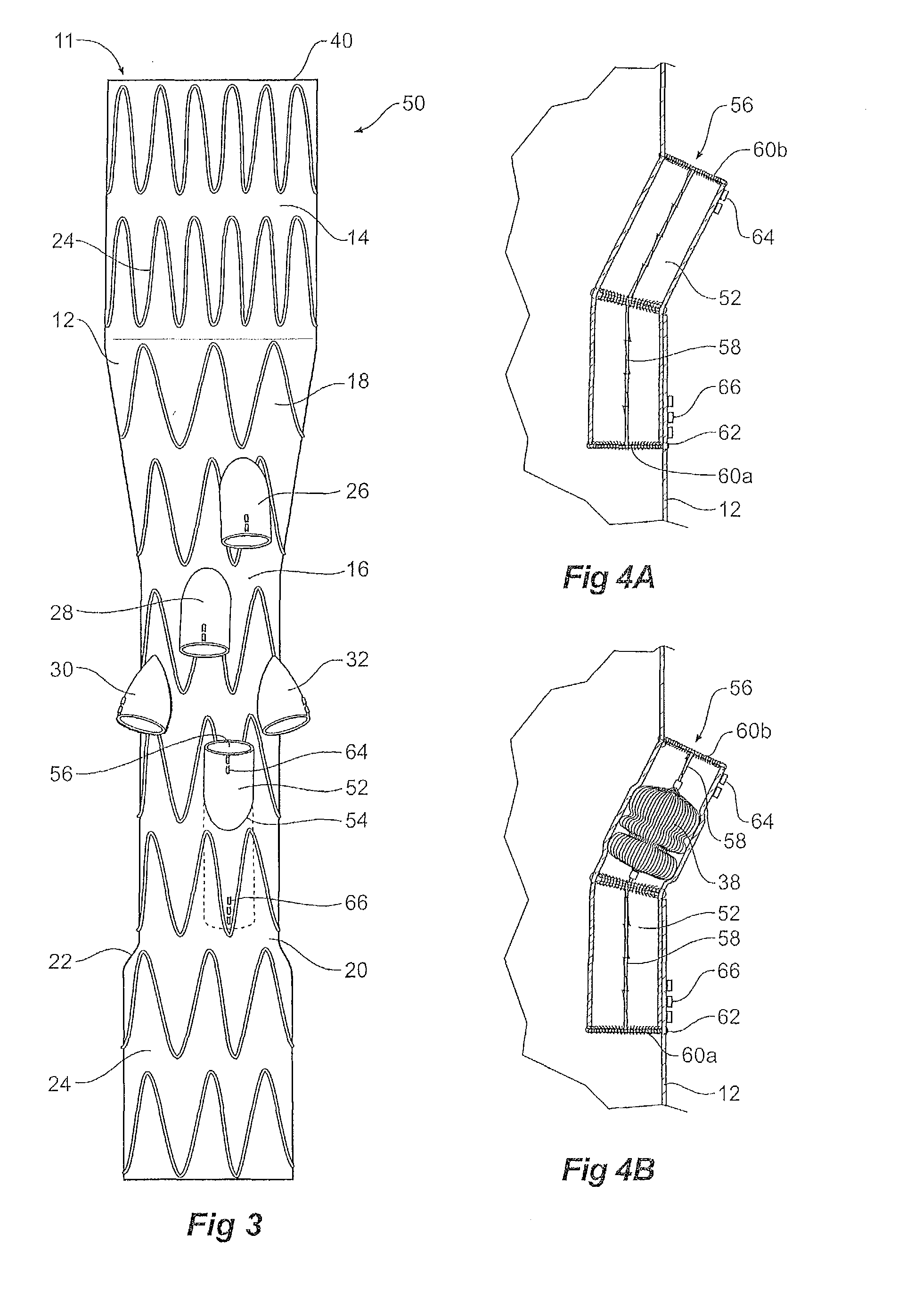 Paraplegia prevention stent graft