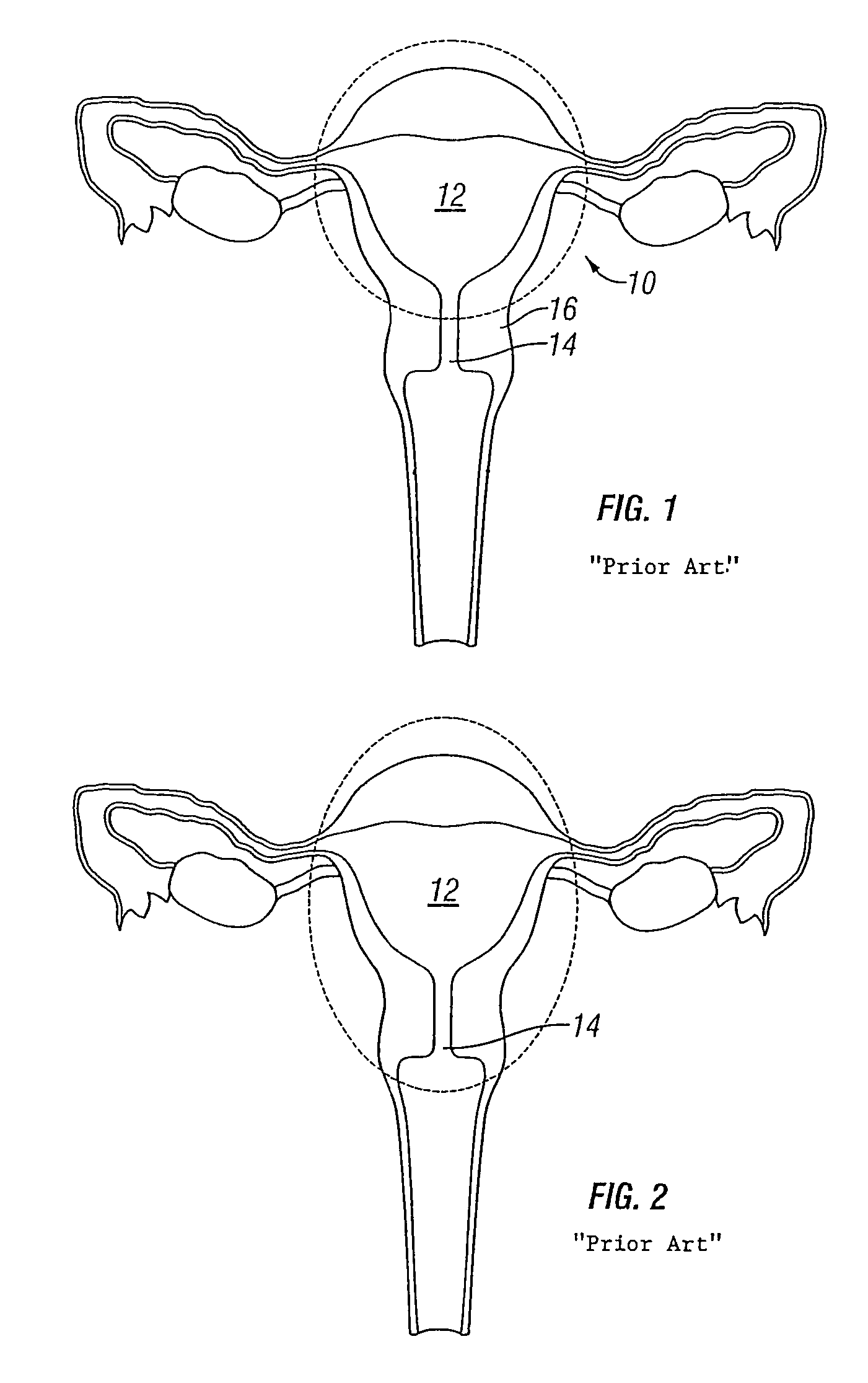 Method and apparatus for creating intrauterine adhesions