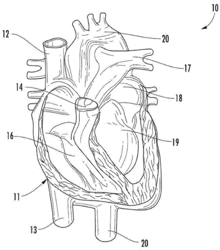 Systems and methods for selectively occluding the superior vena cava for treating heart conditions