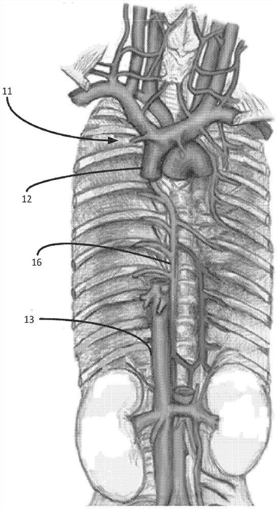 Systems and methods for selectively occluding the superior vena cava for treating heart conditions