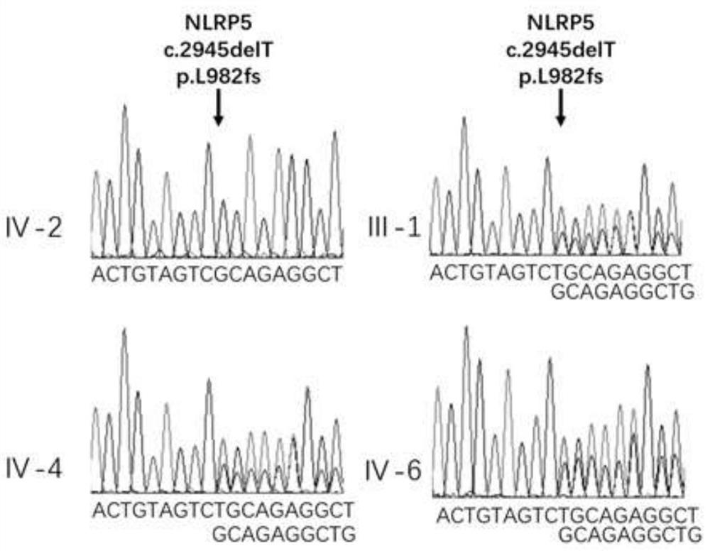 A pathogenic mutation of hereditary primary infertility and its detection reagent