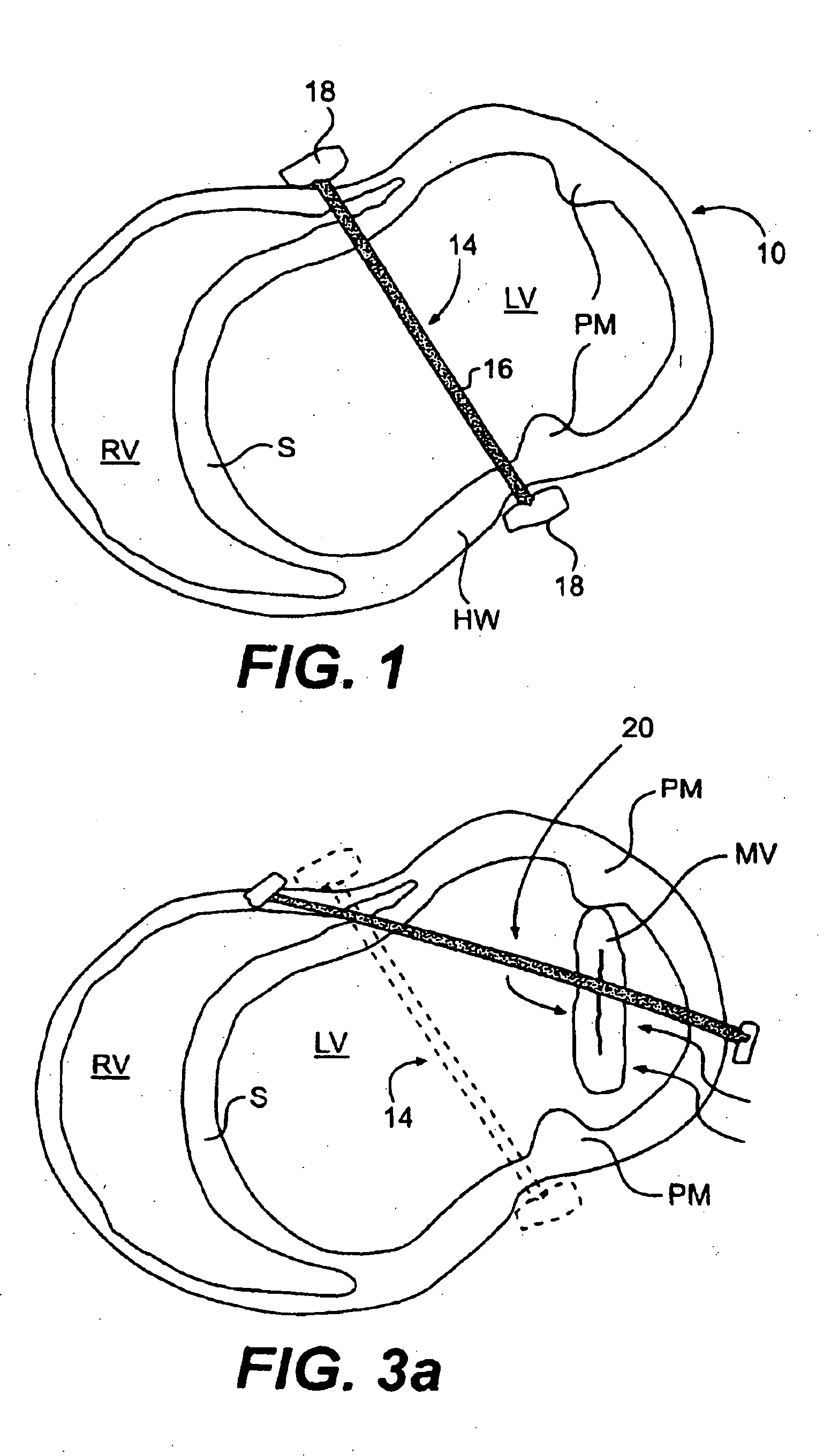 Methods and devices for improving mitral valve function