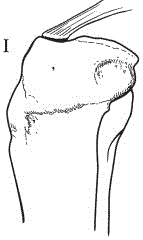 Net bag device for treating ACL tibial avulsion fracture