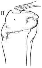 Net bag device for treating ACL tibial avulsion fracture