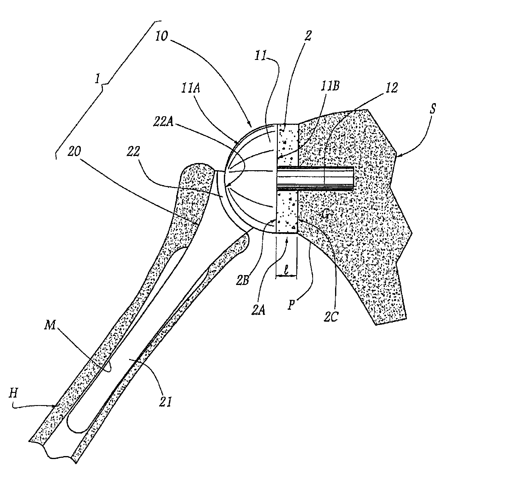 Method and apparatus for fitting a shoulder prosthesis