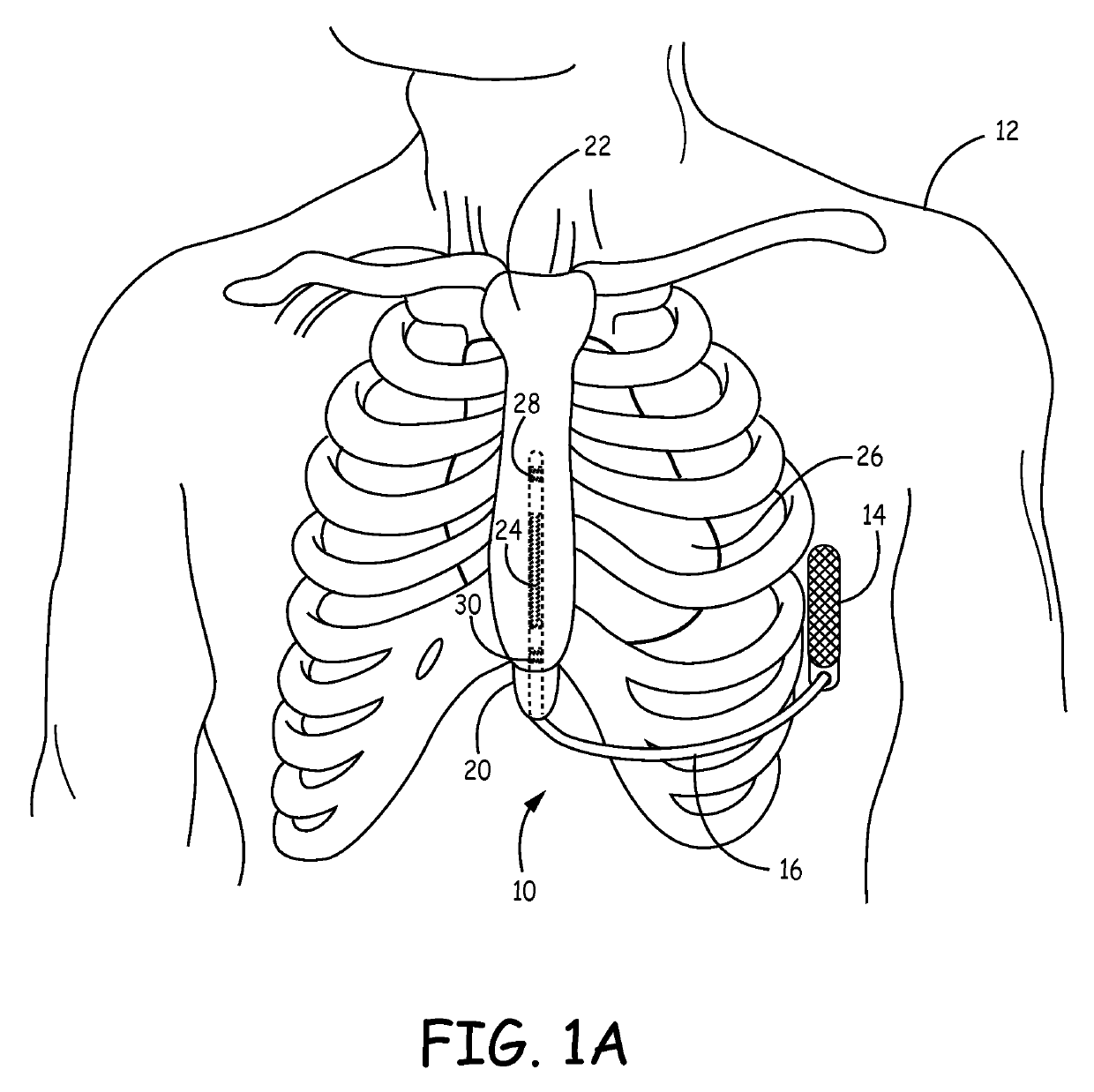 Implantable cardioverter-defibrillator (ICD) system including substernal lead