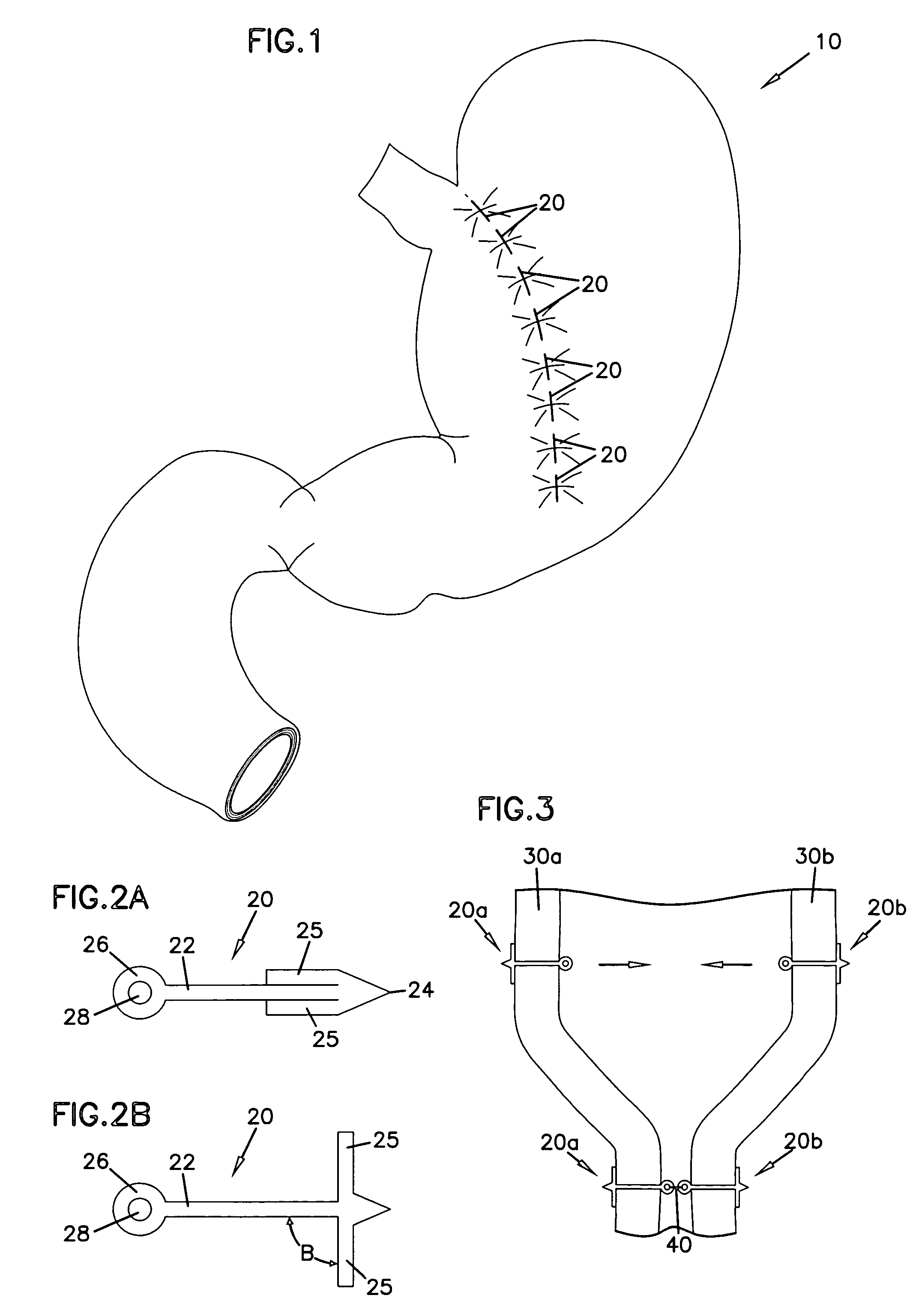 Gastric reshaping devices and methods
